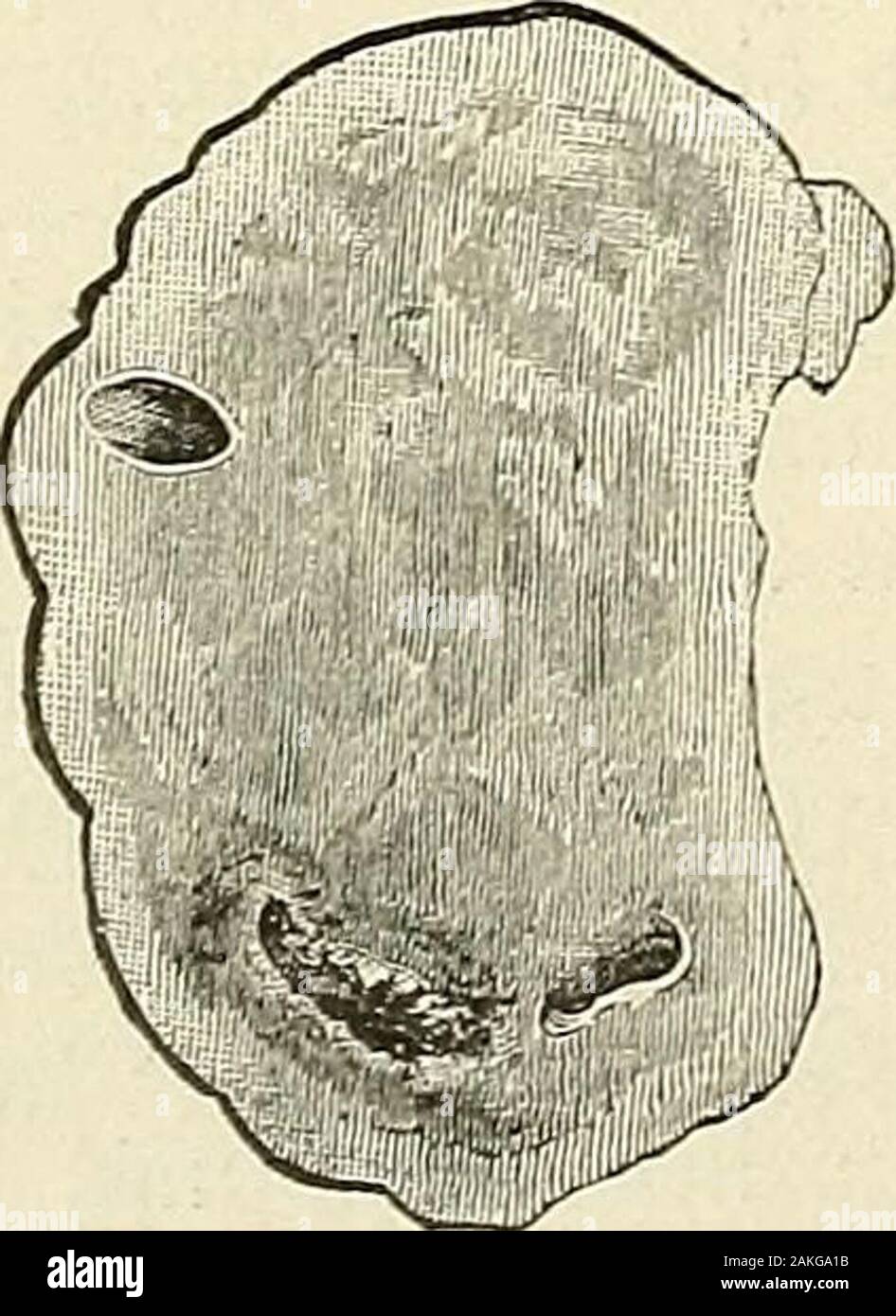 Les maladies de la femme et la chirurgie abdominale . xanthematic la cirrhose de l'ovaire, l'ablation des ovaires heldout des chances de guérir cette malheureuse femme. Au moins itcould pas lui faire pire qu'elle était, pour elle, même si elle diedunder, la libération serait un heureux l'un pour tous les intéressés. Herrelatives, par conséquent, a donné un consentement prêt à ma proposition quand il Ilaid, et le raisonnement sur lequel je me suis basé, avant eux. J'ai donc l'admission du patient à l'hôpital femmes,et, avec l'accord de mes collègues, j'reuioved theovaries le 11 août. L'opération dans le cas de E. E a été effectuée s Banque D'Images