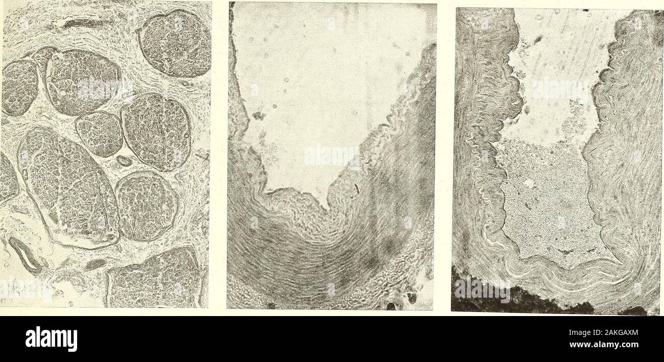 Memorie della RAccademia delle Scienze dell'Istituto di Bologna, Classe di Scienze fisiche ha portato . recederne dellintima conformazione al distacco parziale di una piega che nel sporge lume del Vaso dans ostruendolo parte. 1 X 90. Fig. 9. - Sezione trasversa di un fascio muscolare con necrosi muscolarie accumulo fibre delle di globuli bianchi nelle parti circostanti. 1 X 60. Fig. 10. -- Sezione trasversa di un fascio muscolare in un congelato degenerazionegranulare muscolari ; fibre delle oedème. perifibrillare con 1 X 60. Fig. 11. - Trasversa - Sezione di un fascio muscolare in un congelato ; f Banque D'Images