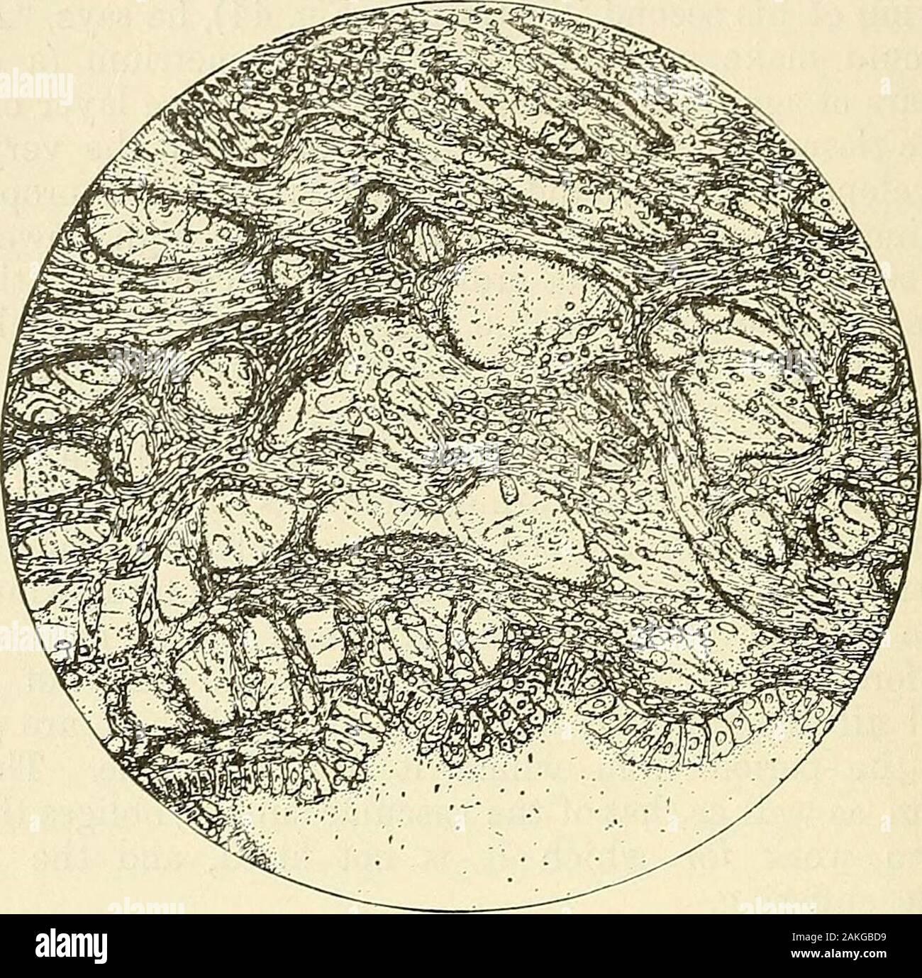 Les maladies de la femme et la chirurgie abdominale . Fig. 44. -La fille de l'endomètre 11 ans d'âge, montrant le développement, nocorpuscular x 800. 328 CELLULAE CHANGEMENTS. Fig. 45.-endomètre de fille de treize ans, menstruatedtvace, montrant début de développement corpusculaire, x 800. Banque D'Images