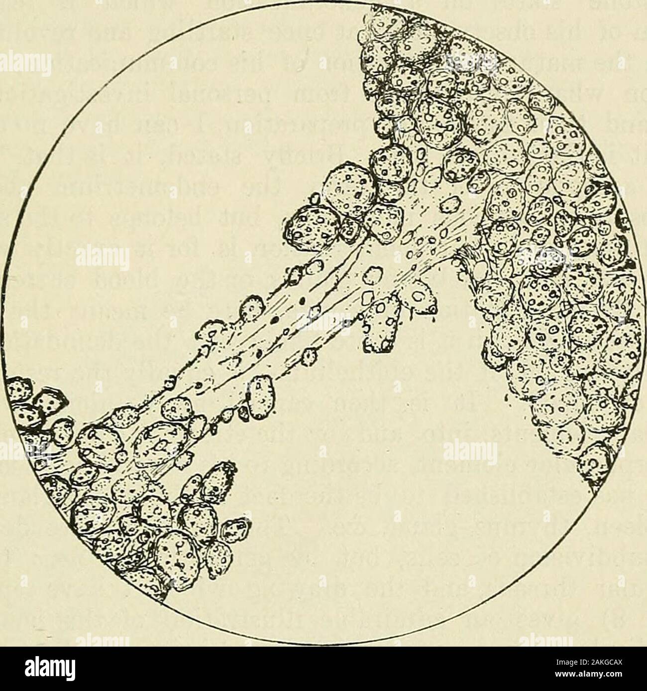 Les maladies de la femme et la chirurgie abdominale . ons, et donc la grossesse dans eux est impossible-conclusions qui sont parallèles à la réalité de la santé comme anddisease. Enfin, l'implantation d'un ovule fécondé peuvent takeplace seulement sur une surface muqueuse saine, fraîchement dénudé ; CELLUl.Ai ; changements, 325 nous avons ici l'explication des faits de la conférence d'ofpregnancies, et l'histoire jusqu'ici est terminée. La JUit intéressant travail de ces deux auteurs a beaucoup d'autres.Pour nous le dire. Avant les règles, dit Sutton, l'(mucus) tis.sueis infiltrés partout aux angles arrondis et de forme irrégulière Banque D'Images