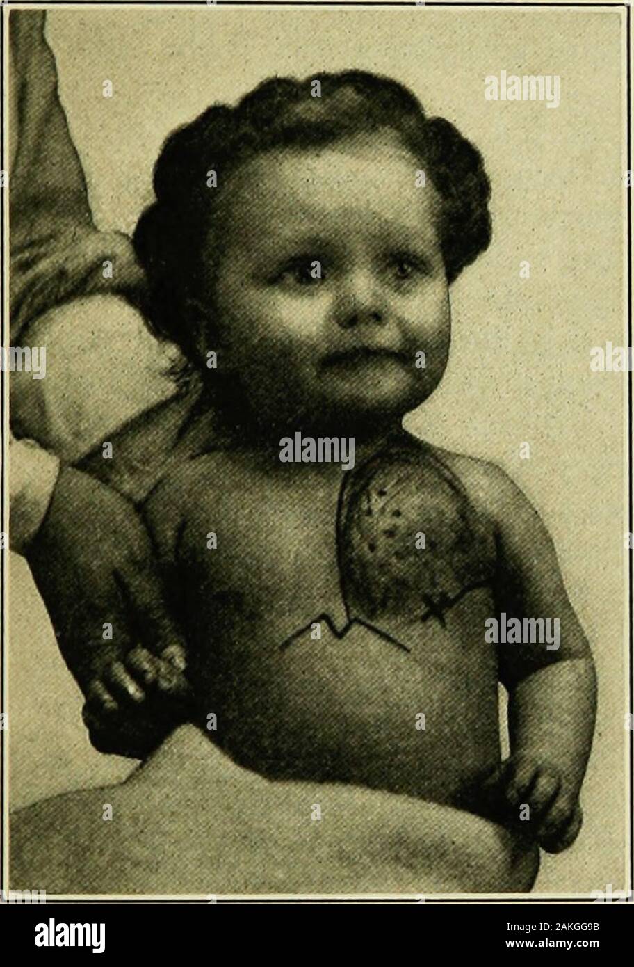 La pratique de la pédiatrie . isextensive olidation, la résistance et l'dulness peut, dans une certaine mesure, simuler celle de l'épanchement. Lorsqu'il en est ainsi, il est parfois dû à une couche d'fluidoutside les poumons solides, mais pas toujours. Autour de la zone consolidée note de percussion hors teintes progressivement dans celui de poumon sain, de pneumonie lobaire 635 si la note peut être en forme de plus de zones. Parfois, thepercussion tympanitic note peut être vraiment sur le poumon pneumonique, andthis plus communément, je pense que, lorsque le processus fait l'apex (Fig. 138). L'auscultation.-Les bruits respiratoires au tout début Banque D'Images