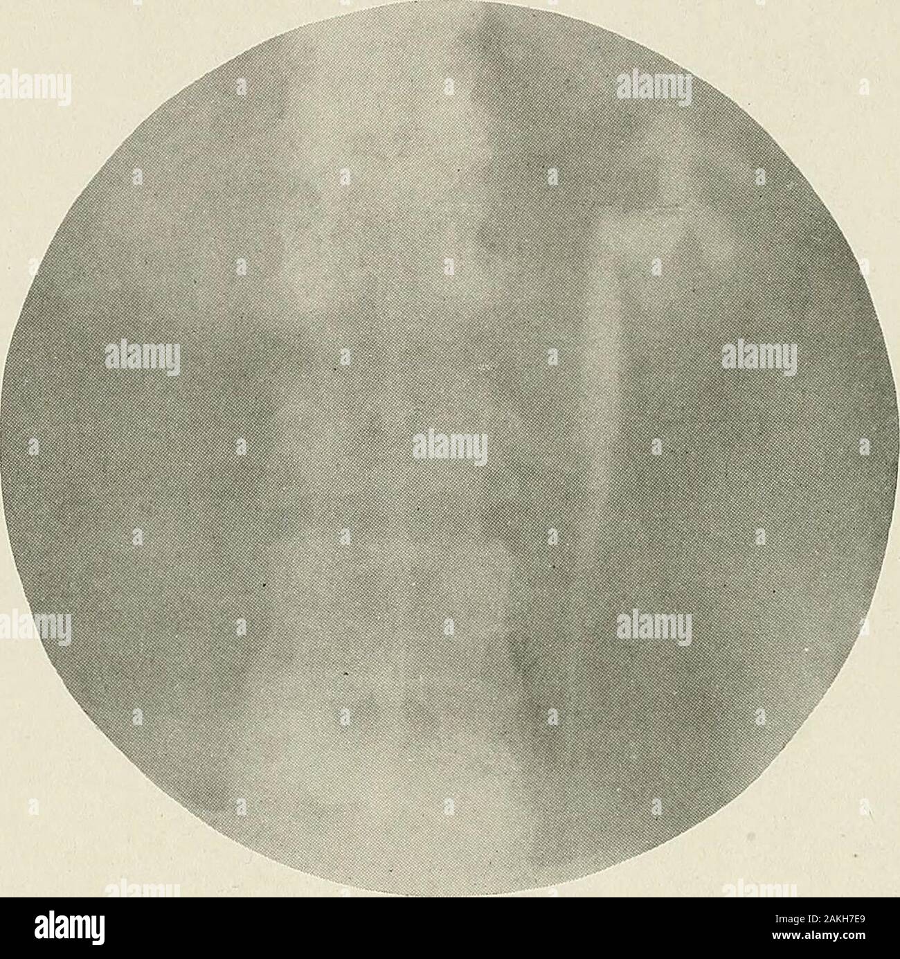(Pyelo-ureterography La pyélographie) une étude de l'anatomie normale et pathologique du bassinet et l'uretère . Fig. 124.-inflammatoire dilatation. 158 l'angulation pyélographie visible dans la première partie du droit même ureteris de meilleures données sur les processus inflammatoires thanthe légère dilatation. Dans la Fig. 125 l'uretère supérieur est mod-erately dilaté et est très inclinée à l'ureteropelvicjuncture. Le calice, bien que l'ascidie, sont, lesen même temps que le bassin vrai, exceptionnellement faible. Dans la Fig. Le truepelvis 126 est à peu près la même taille que l'uretère supérieur, et le. Fig. 125.-inflammatoire dilata Banque D'Images