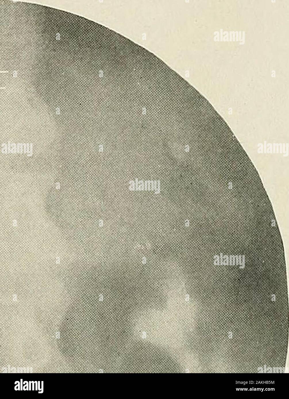 (Pyeloureterography La pyélographie) une étude de l