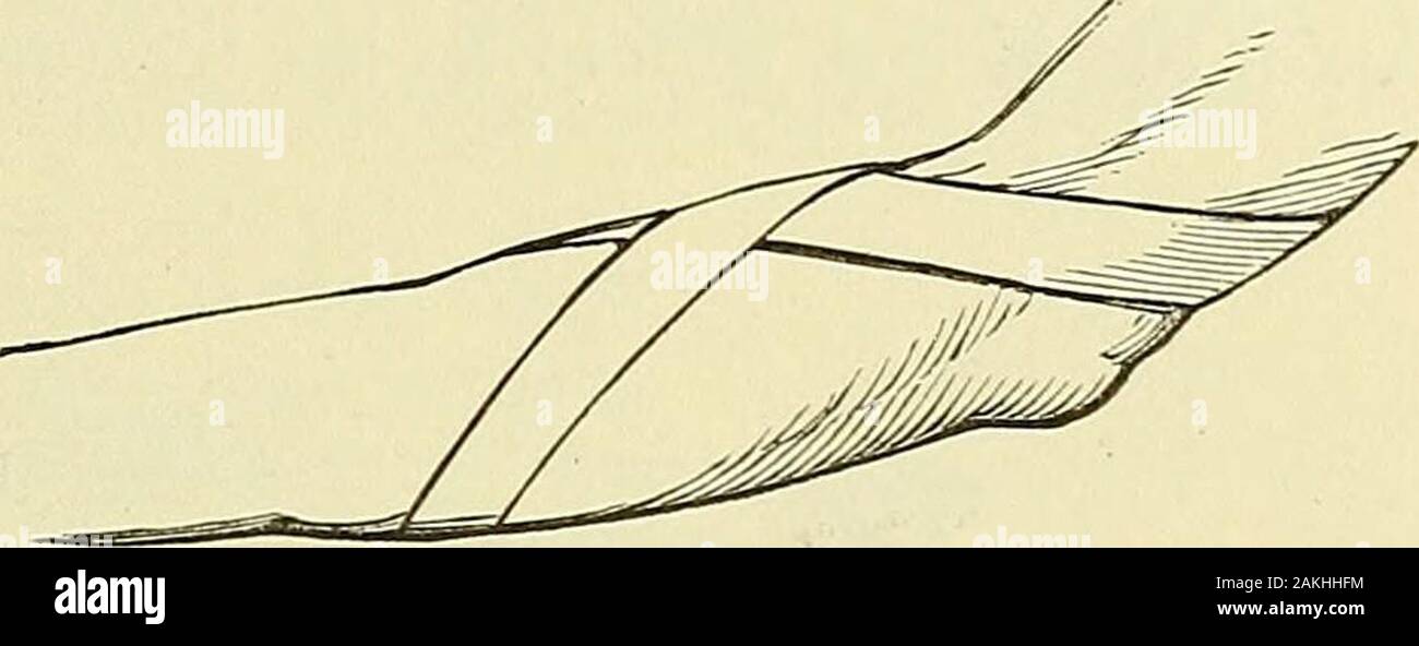 Un manuel de la chirurgie moderne : une exposition des doctrines et des procédures approuvées de l'heure actuelle, à l'usage des étudiants et praticiens . proposition peut être prudemment fait afterthree semaines, mais doit être omis s'il provoque une réaction inflammatoire.Lorsqu'il y a peu de tendance à la séparation et la flexion ne Fig. 209. n'augmentera pas le déplacement, le membre peut être traitée en position fléchie, asemi-si exten-sion provoque de l'inconfort. Whengreat resultedfrom le handicap a long greatimprovement fibreux, l'union a été obtainedby exposant l'os, rafraîchissez-ing les extrémités et faste Banque D'Images