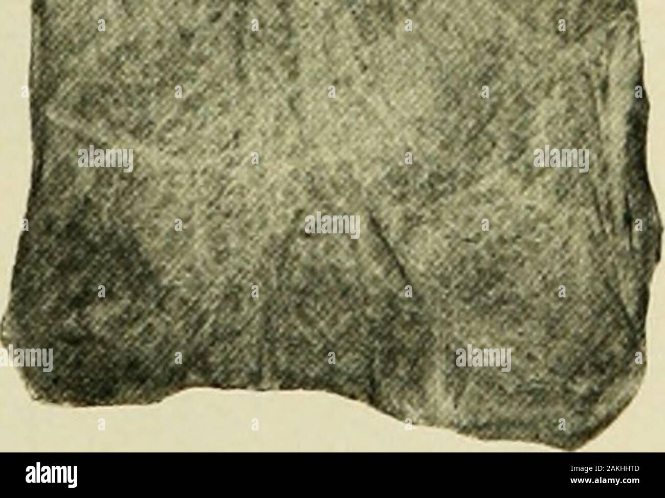 La pratique de pédiatrie . L'hypertrophie des PeyerB dans le petit intestin, les correctifs avec superficialerosions ressemblant à des ulcères. Ulcères tuberculeux de l'intestin grêle. Le lowestportion présente le patch Peyers, juste au-dessus de l'ileocecalvalve, un siège favori d'ulcération d'aucune sorte. S XFECTIOI 372 I.miliaire maladies des tubercules. Il peut contenir de grandes masses tuberculeuses, ou d'une exsudation d', alors ceci est dû à un point de presse dans le péritoine, ou à l'un des con-ditions décrit sous la péritonite tuberculeuse. Symptomatologie.-Ces sont complètement illimitée dans la grande majorité des cas. Il n'est pas rare de trouver Banque D'Images