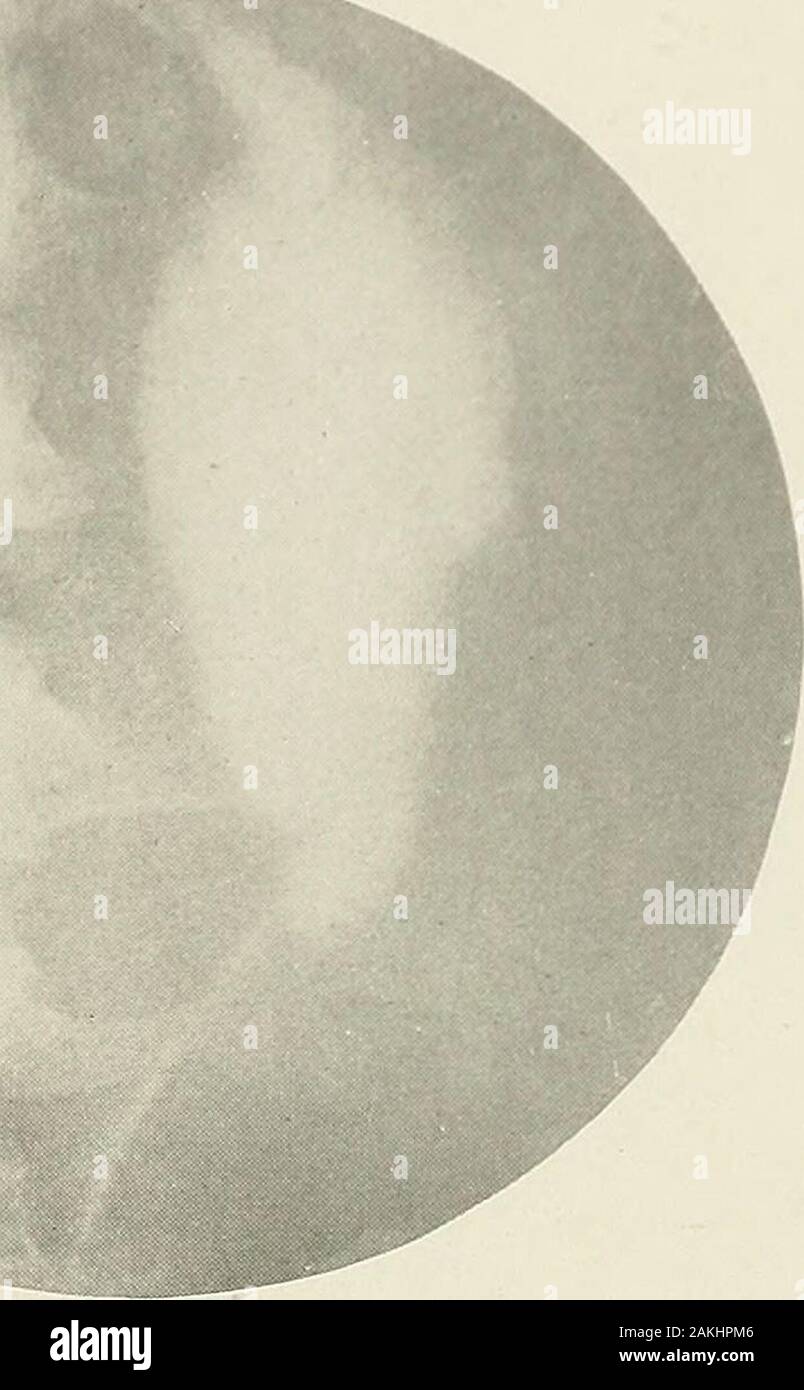 (Pyelo-ureterography La pyélographie) une étude de l'anatomie normale et pathologique du bassinet et l'uretère . Fig. 86.-l'hydronéphrose. Fig. 86 les papilles sont réduites à de simples dépressions partiallyseparating la présentation abrégée de grands calices. Dans la Fig. 87 Le bassin vrai est dilaté dans plus proportionthan les calices. Son doux, rond border est typique ofmechanical dilatation. Dans la Fig. 88 Le bassin vrai dis-tinctly est plus grand que la normale. Les calices sont petites, ow-ment sur le fait que le bassin est partiellement rempli mais. Thecapacity de l'ensemble bassin serait d'environ 100 cc. PYE 118 Banque D'Images (Pyelo-ureterography La pyélographie) une étude de l'anatomie normale et pathologique du bassinet et l'uretère . Fig. 86.-l'hydronéphrose. Fig. 86 les papilles sont réduites à de simples dépressions partiallyseparating la présentation abrégée de grands calices. Dans la Fig. 87 Le bassin vrai est dilaté dans plus proportionthan les calices. Son doux, rond border est typique ofmechanical dilatation. Dans la Fig. 88 Le bassin vrai dis-tinctly est plus grand que la normale. Les calices sont petites, ow-ment sur le fait que le bassin est partiellement rempli mais. Thecapacity de l'ensemble bassin serait d'environ 100 cc. PYE 118 Banque D'Images