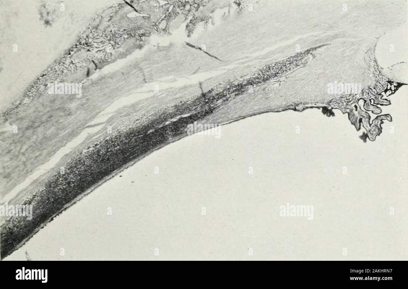 Transactions . eply infiltré mais non épaissi, et la saine descrip-tion s'applique aux procès ciliaires ; cette infiltration est indirecte la continuité avec celle de la racine d'iris. Sur le outeraspect ciliaiy du muscle, et n'est pas connecté avec theinfiltration vient de le mentionner, il y a une infiltrationforming une épaisse couche de lymphocytes qui sépare l'theciliary muscle et pars plana de la sclère, et est marqué ci-dessous qu'au-dessus de muchmore (PI. IX, fig. 5). Le muscleand la pars plana sont eux-mêmes relativement littleinvaded. Dans les lieux les fibres de la plaque sont muscles ciliaires IX. Banque D'Images