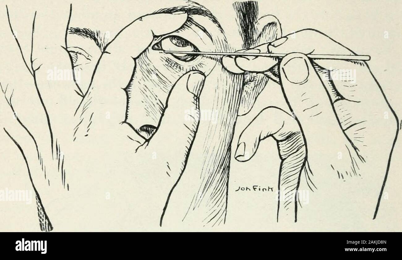 Atlas et incarnation de coopératives d'ophtalmologie . Fig. 149.-dilatation de la basse canalicule lacrymal : première étape. Le tissu entourant le canalicule, durable severaldays. Pour cette raison, si l'opérateur n'est pas tout à fait sûr il ofhimself devraient utiliser une solution saline physiologique whenhe effectue son premier l'irrigation. Solutions médicamentées thatmay être bichlorid sont recommandés de mercure, 1 : 5000 jusqu'à 1:1000 ; protargol, 5 à 10  %.  ; [Argyrol, 10 à 25 p. 100.-Ed.] ; ou de nitrate d'argent, zinc 1  %.,etc. Une précaution importante consiste à injecter les 352 OPÉRATIONS SUR L'ŒIL.. Fig. Banque D'Images