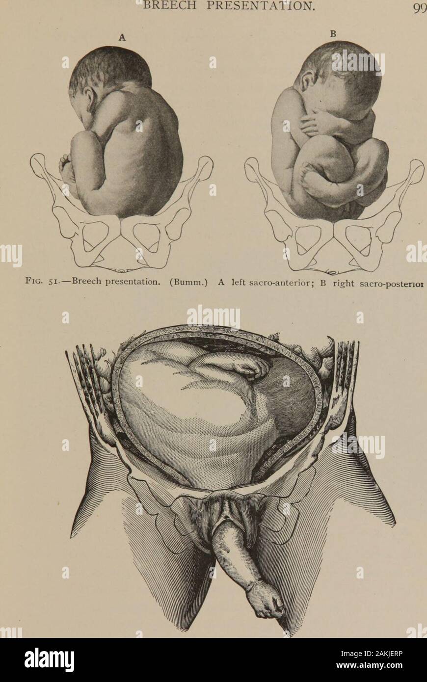 Notice d'une infirmière de l'obstétrique . Fig. 50.-Face présentation. (Boum.). Fig. 52.-Prolapsus de bras en présentation transverse. (Tarnier et Chantreuil.) UN MANUEL D'INFIRMIÈRES DE L'obstétrique. D'autres présentations, qui sont tous très rares, sont ceux du pied, bras (Fig 52), ou à l'épaule. L'étude du mécanisme de l'autre presenta-tions et des positions est l'une d'un grand intérêt, mais le mémoire d'outlinegiven le mécanisme en position antérieure de l'occiput isall qui concerne directement l'infirmière. Tous les autres cas sont plus orless, anormale, et que leur progression est généralement lente, leur ma Banque D'Images