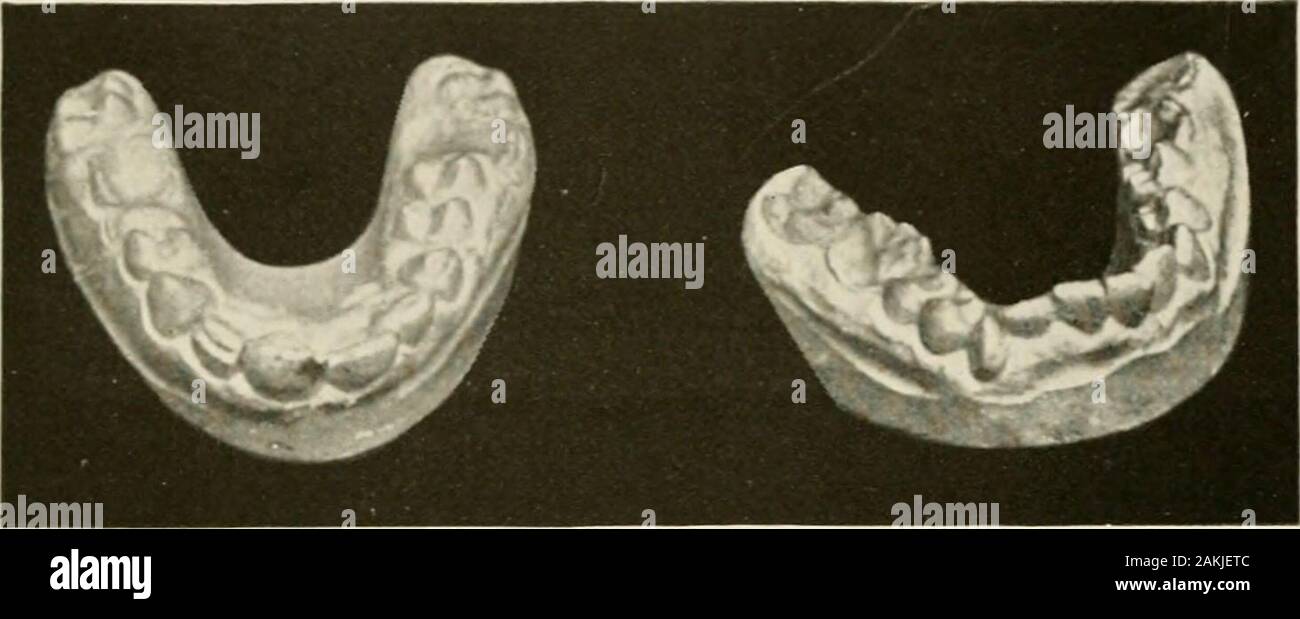 Pathologie dentaire général et, en particulier, sur l'étiologie et de l'anatomie pathologique ; un traité pour les étudiants et les praticiens . e. Nid d'érosions. (Cavallaro. ) Le résultat de troubles nutritionnels induits par l'presenceor introduction du virus syphilitique dans l'enfant (Fig. 231à 236). À cette source, parmi beaucoup d'autres, mais pas exclusivement, peut être retracé la décalcification en retard des dents,et l'éruption de la fin d'autant leur suc-cessors permanente ; l'absence de certaines dents, tels que la partie supérieure ou inférieure du lateralincisors prémolaires ; le développement o Banque D'Images