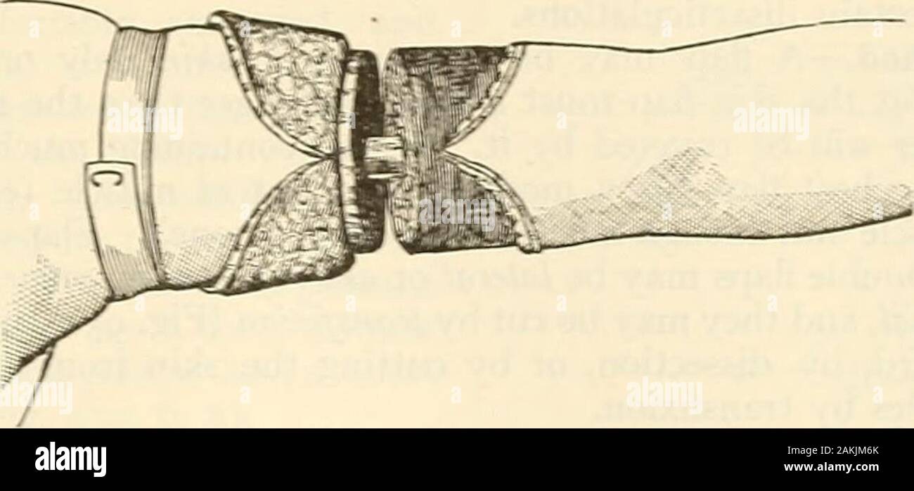 La chirurgie moderne, général et du dispositif . Fig. 953.-circulaire l'amputation : dissection de la peau-trappe (Esmarch). C'est que l'incision circulaire serrucho hes directement à la fin de la souche andis susceptible de provoquer de la douleur lorsque l'objet de pressions. Méthode circulaire modifiée.-Dans cette opération la peau circulaire-cut peut-être modifié en faisant une incision verticale pour rejoindre la première blessure, les muscles. Méthode circulaire oblique d'amputer de 140 ; le fait d'être coupé par une incision circulaire sweep (racket) ou en faisant deux venicalskin ^incisions de rabats rectangulaires). L'incision est faite par lancéolées- ronde. Fig. 954..-Modif Banque D'Images