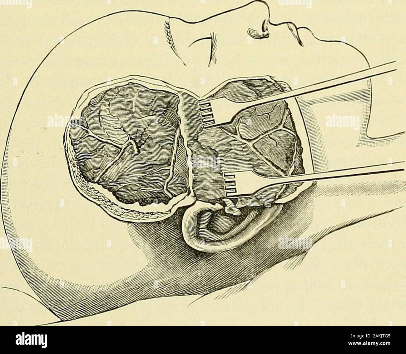 Un manuel de la chirurgie moderne : une exposition des doctrines et des procédures approuvées de l'heure actuelle, à l'usage des étudiants et des praticiens . Vue latérale de la mâchoire inférieure, montrant la position de l'openingin trephine l'opération pour l'approfondissement de l'encoche sigmoïde. Le dottedlines au-dessus de l'ouverture trephine indiquer la mesure du pont de l'os qui doit la dépose. Les soins dentaires de qualité inférieure canaland ses ouvertures antérieur et postérieur sont indiqués.. Volet Osteoplastic tourné vers le bas, exposant la dure-mère et du meniugeal artère. L'brainand dura sont ensuite poussés vers le haut afin d'ex Banque D'Images Un manuel de la chirurgie moderne : une exposition des doctrines et des procédures approuvées de l'heure actuelle, à l'usage des étudiants et des praticiens . Vue latérale de la mâchoire inférieure, montrant la position de l'openingin trephine l'opération pour l'approfondissement de l'encoche sigmoïde. Le dottedlines au-dessus de l'ouverture trephine indiquer la mesure du pont de l'os qui doit la dépose. Les soins dentaires de qualité inférieure canaland ses ouvertures antérieur et postérieur sont indiqués.. Volet Osteoplastic tourné vers le bas, exposant la dure-mère et du meniugeal artère. L'brainand dura sont ensuite poussés vers le haut afin d'ex Banque D'Images