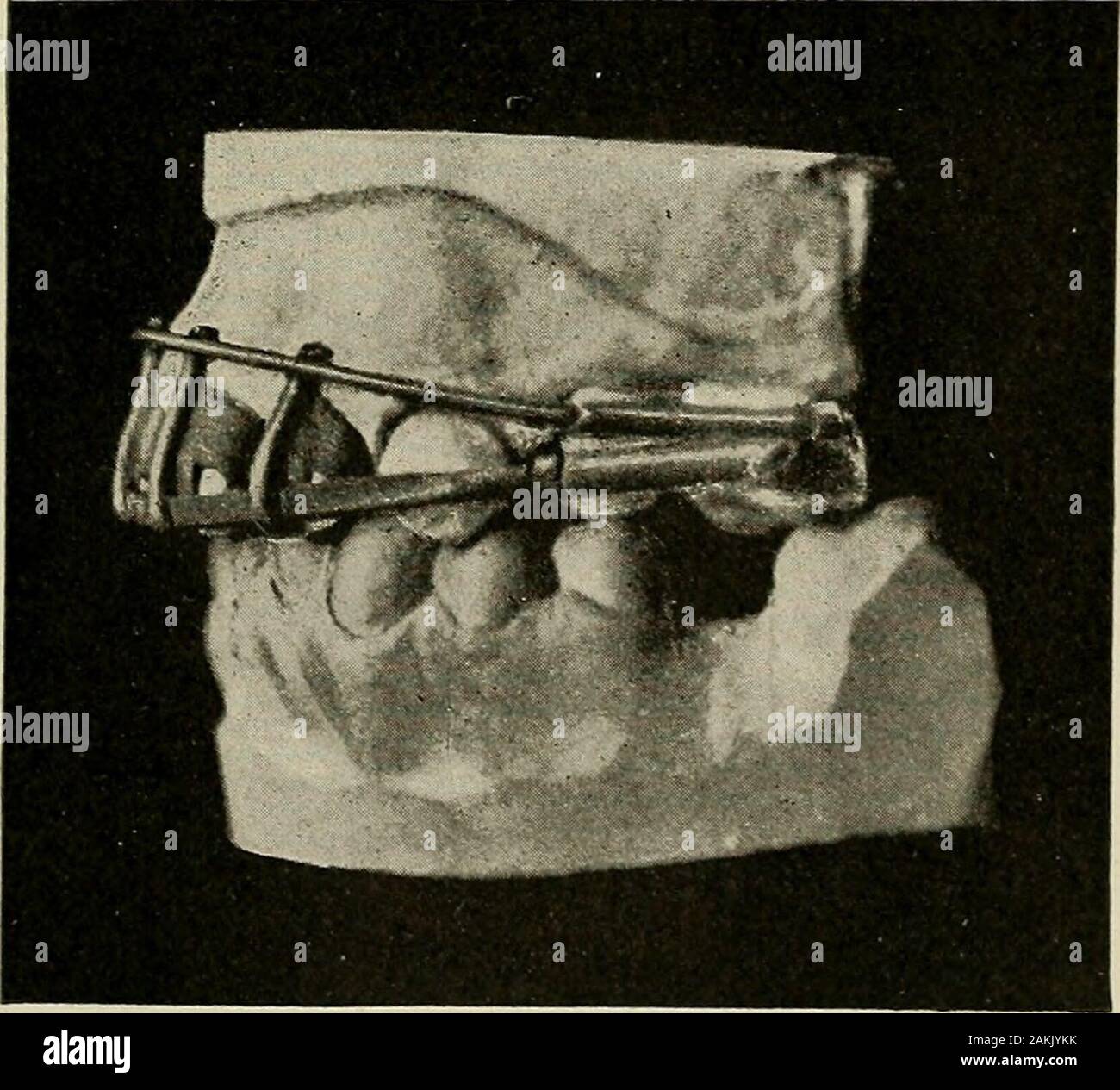 Pratique d'un traité sur l'art dentaire mécanique . paratus décrites, nous tenons à attirer l'attention sur le fait que le travail consacré à l'ancrage des pièces jointes est en grande partie par la neu-tralized influence alternatif des deux forces, et cette Fig. 263.. Appareil d'Retruding en position. réciprocité est toujours égale à la puissance utilisée sur le fulcrumbar à empêcher un mouvement de l'occlusion de extrémités de thecrowns. L'équilibre de la puissance, qui peuvent être considérables30 Fig. 264. Banque D'Images