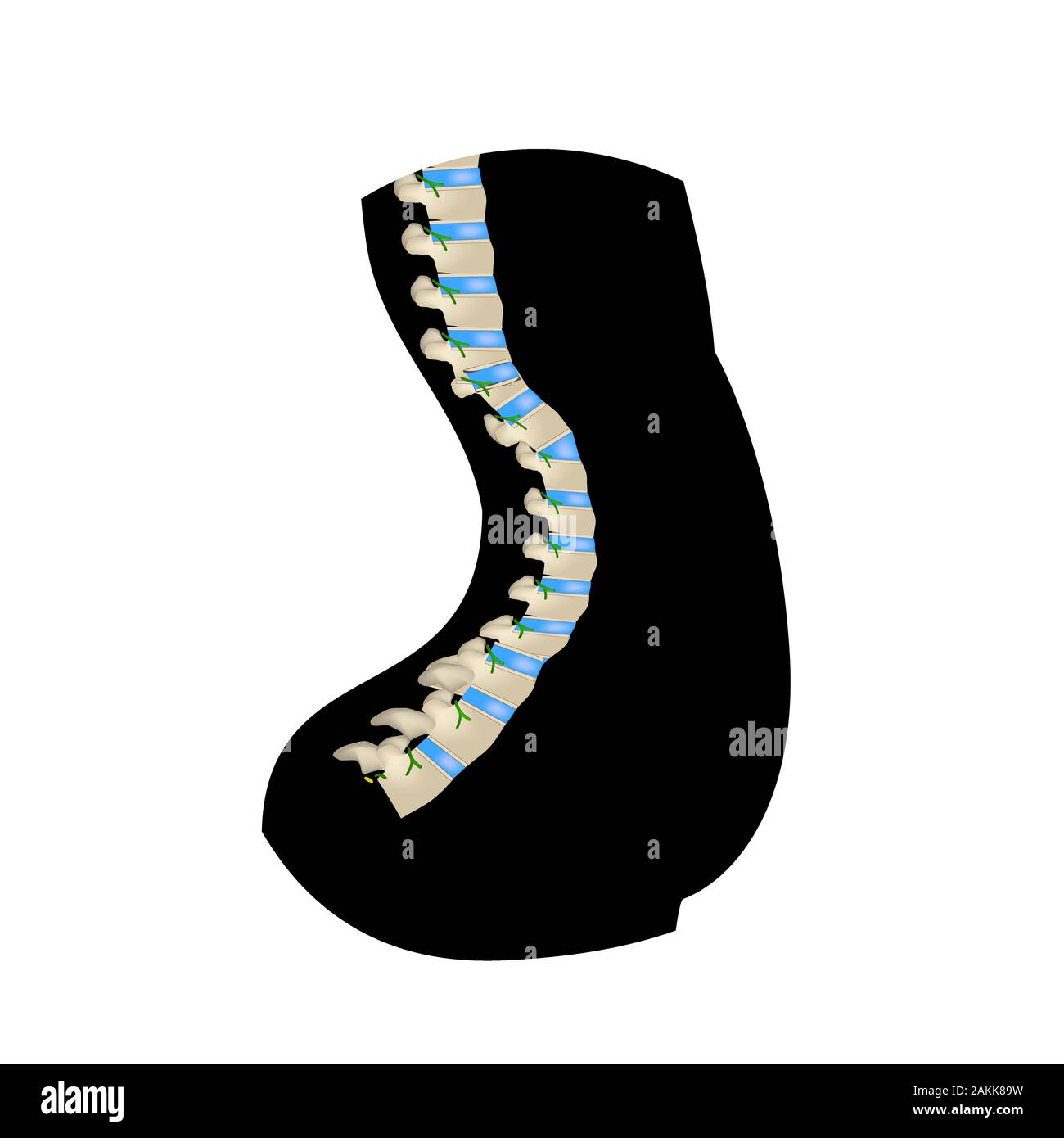 La position de la colonne vertébrale de la lordose avec. Icône silhouette noir et blanc. La courbure de la colonne vertébrale, la scoliose, lordose, cyphose, arthrose. Mauvaise posture Illustration de Vecteur