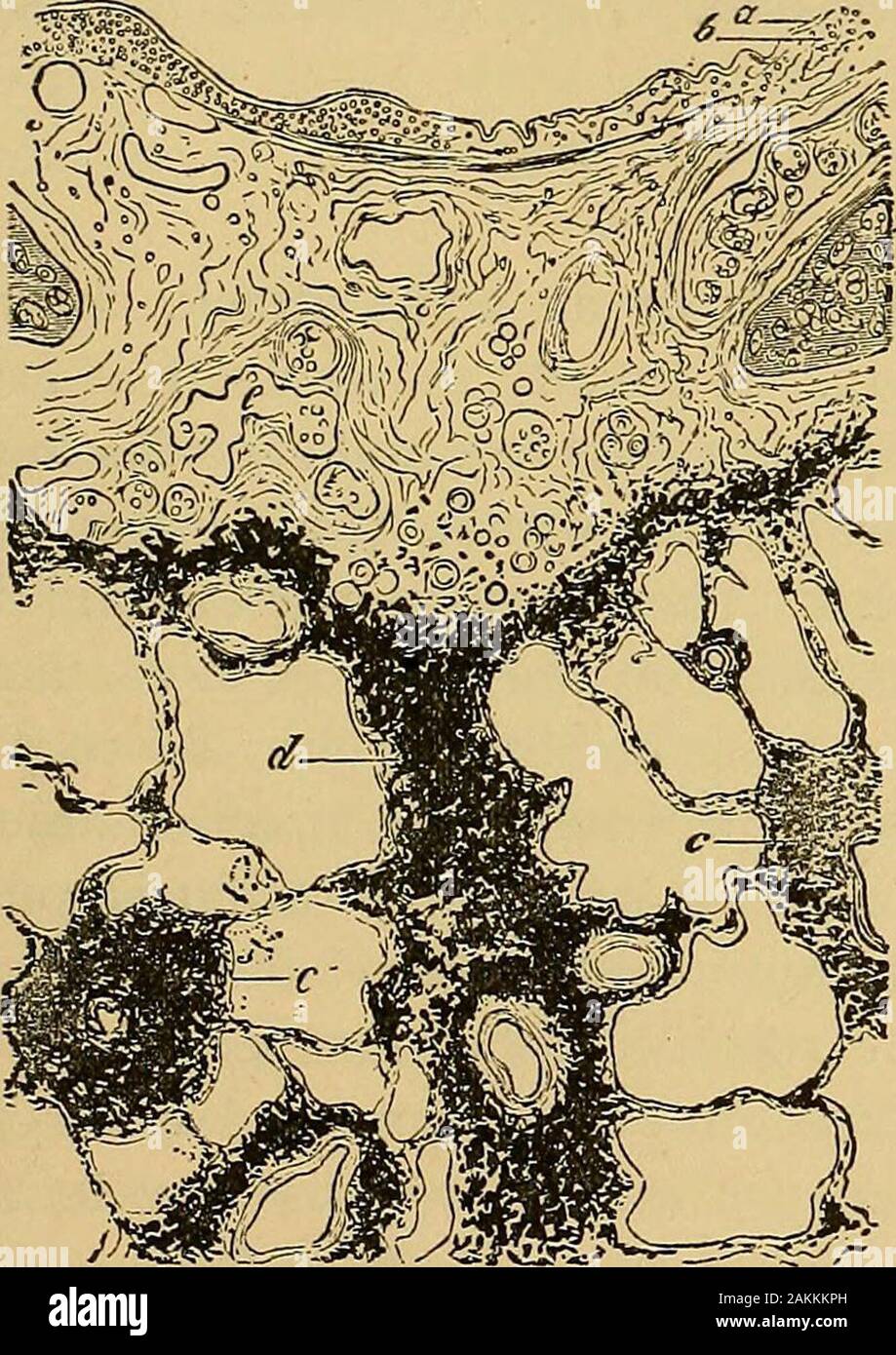 La consommation pulmonaire, pneumonie, et des maladies des poumons : l'étiologie, la pathologie et le traitement, avec un chapitre sur le diagnostic physique . 300. Un Diams, lumen bronchique, avec les muqueuses dans membranethrown ; plis b, congestion des capillaires ; r, desquamated et pig-œuvre ; d épithélium alvéolaire alvéolaire des poumons, des cavités.-Hamilton. la bronchite, mais parce que ses vaisseaux sanguins sont andturgid distendu. Chaque texture semble être dans un con-dition oedémateux. En règle générale, l'épithélium est de vouloir, et sur l'freesurface de la membrane de sous-sol, ce qui est gonflé, andedematous sont des nombres de bud-comme Banque D'Images
