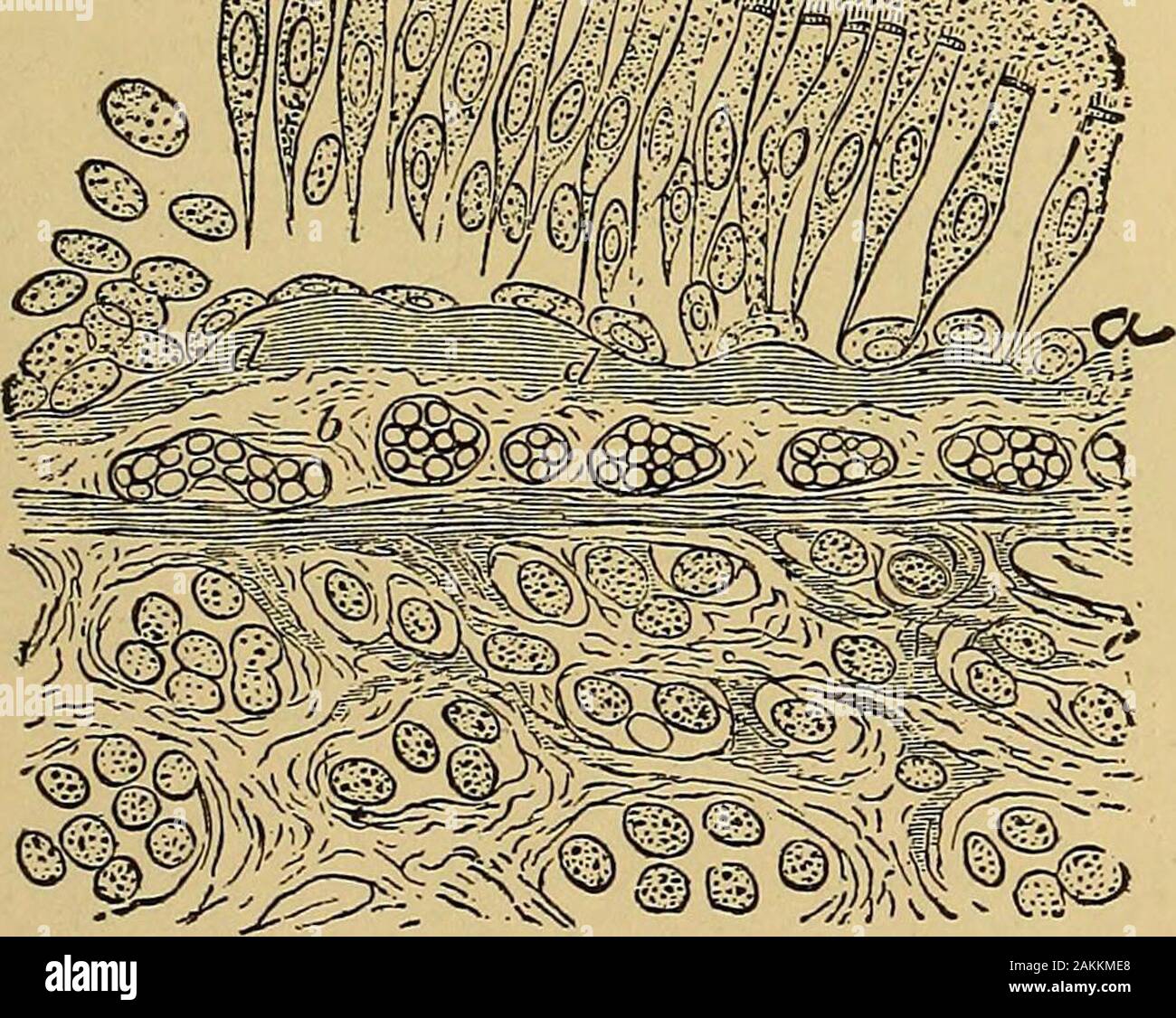 La consommation pulmonaire, pneumonie, et des maladies des poumons : l'étiologie, la pathologie et le traitement, avec un chapitre sur le diagnostic physique . ree ou quatre jours est entièrement enlevés.C'est bien illustré dans les figures suivantes qui aretaken à partir de l'action de M. D. J. Hamilton, qui a déjà été largement cité, et qui sera une takenas guide dans tout ce qui se rapporte à l'pathologyof bronchite chronique, à la fois sa forme aiguë et chronique. En raison de l'oedème, qui est présent dans la bronchite chronique, l'apportée dans d'expectoration séreuse est principalement de caractère, une bronchite aiguë. Banque D'Images