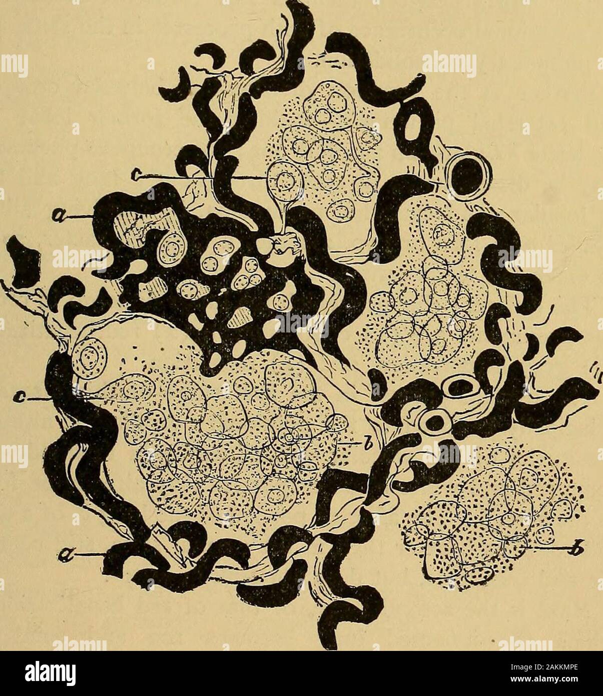 La consommation pulmonaire, pneumonie, et des maladies des poumons : l'étiologie, la pathologie et le traitement, avec un chapitre sur le diagnostic physique . Fig- 39--Section d'une alvéole de poumon d'un personne qui diedfrom, une maladie de la valve mitrale, distendu et capillaires alvéolaires en saillie;b, desquamated ; c, l'épithélium-intoalveolar extravasated sang globules empreinte à Hamilton. Rhumatisme parfois, une pneumonie et une pleurésie croupous,au lieu d'un œdème pulmonaire, sont engendrés. Maintenant, il y a de bonnes raisons de croire qu'catarrhalpneumonia est dépendante de l'exploitation de la même mor-bid principe, bien Banque D'Images