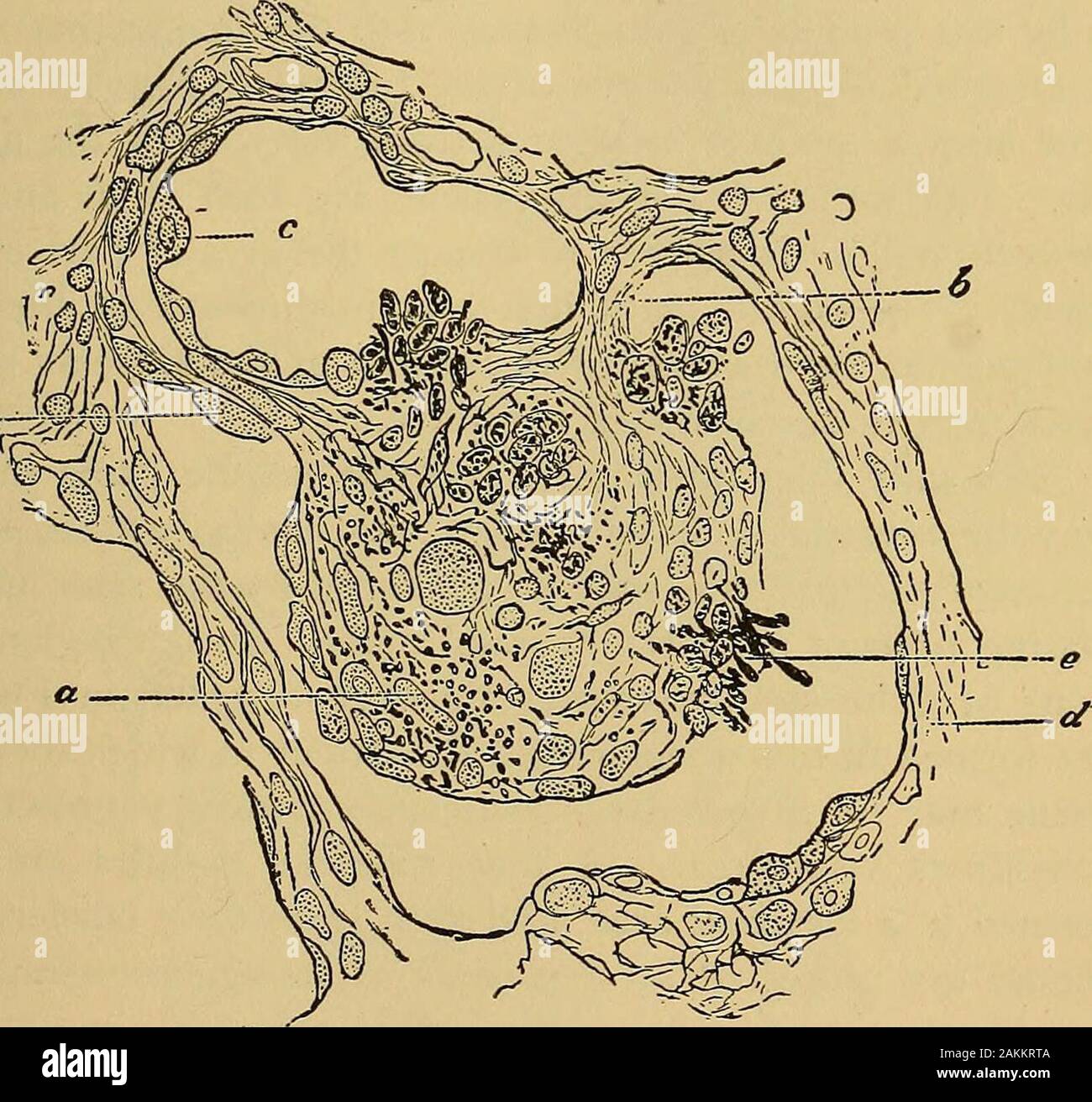 La consommation pulmonaire, pneumonie, et des maladies des poumons : l'étiologie, la pathologie et le traitement, avec un chapitre sur le diagnostic physique et se propage . La messe,vers l'extérieur jusqu'à ce qu'il établit la communication avec abronchial tube lorsque son contenu est déchargée et une cavityin le poumon reste, comme cela a déjà été noté. Caseation marque le début d'une nouvelle époque dans l'histoire de vie de la consommation pulmonaire. Depuis le tout début de ce processus et même après l'excavation a occurredtubercle bacilli, qui presque toujours montrer leur presenceat cette fois, sont absorbés par le système lymphatique vesse Banque D'Images