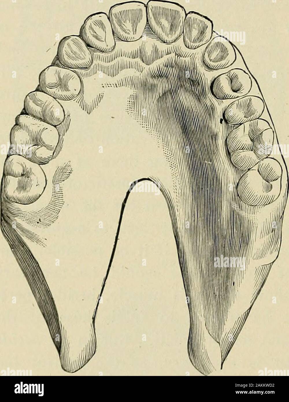 Pratique d'un traité sur l'art dentaire mécanique . fente palatine, en 1844, membres distinctement que le constrictor est veryfull, et il a également affirmé que le muscle de l'avant très décidé ac-tion dans la déglutition. M. Kingsley, en parlant de Suersens appliance, dit : Tout d'abord, que de tous les obturateurs c'est la meilleure forme pour fissure congénitale,mais si le porteur n'est permis d'exprimer avec une telle instru-ment, c'est seulement après qu'il a appris l'articulation avec un autre ap- 396 MÉDECINE DENTAIRE MÉCANIQUE. paratus. En deuxième lieu, qu'un doux, élastique, velum artificiel est bien betteradapted à l'acquisition d'articul Banque D'Images