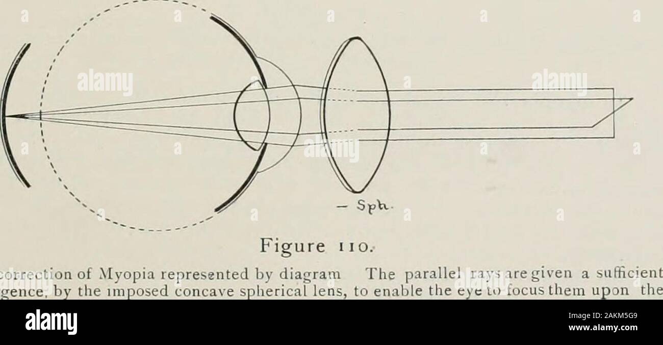 La réfraction oculaire et l'ombre test . oeil. Rayons parallèles d'lightrcle en passant par le principal la correction de la myopie est une lentille sphérique concave de ce poiveithat couthincd ivith le système de réfraction de l'œil, leur principalfocus ivill soient sur la rétine.. La correction de la myopie représenté par le diagramme, parallidivergence par la lentille sphérique concave imposées, pour permettre à la figure 109 permettent de représenter une vue en coupe d'un oeil myope, theparallel les rayons de lumière sont vus à converger à l'accent principal, qui en avant de la rétine, et ensuite diverger d'atteindre la rétine comme un Banque D'Images