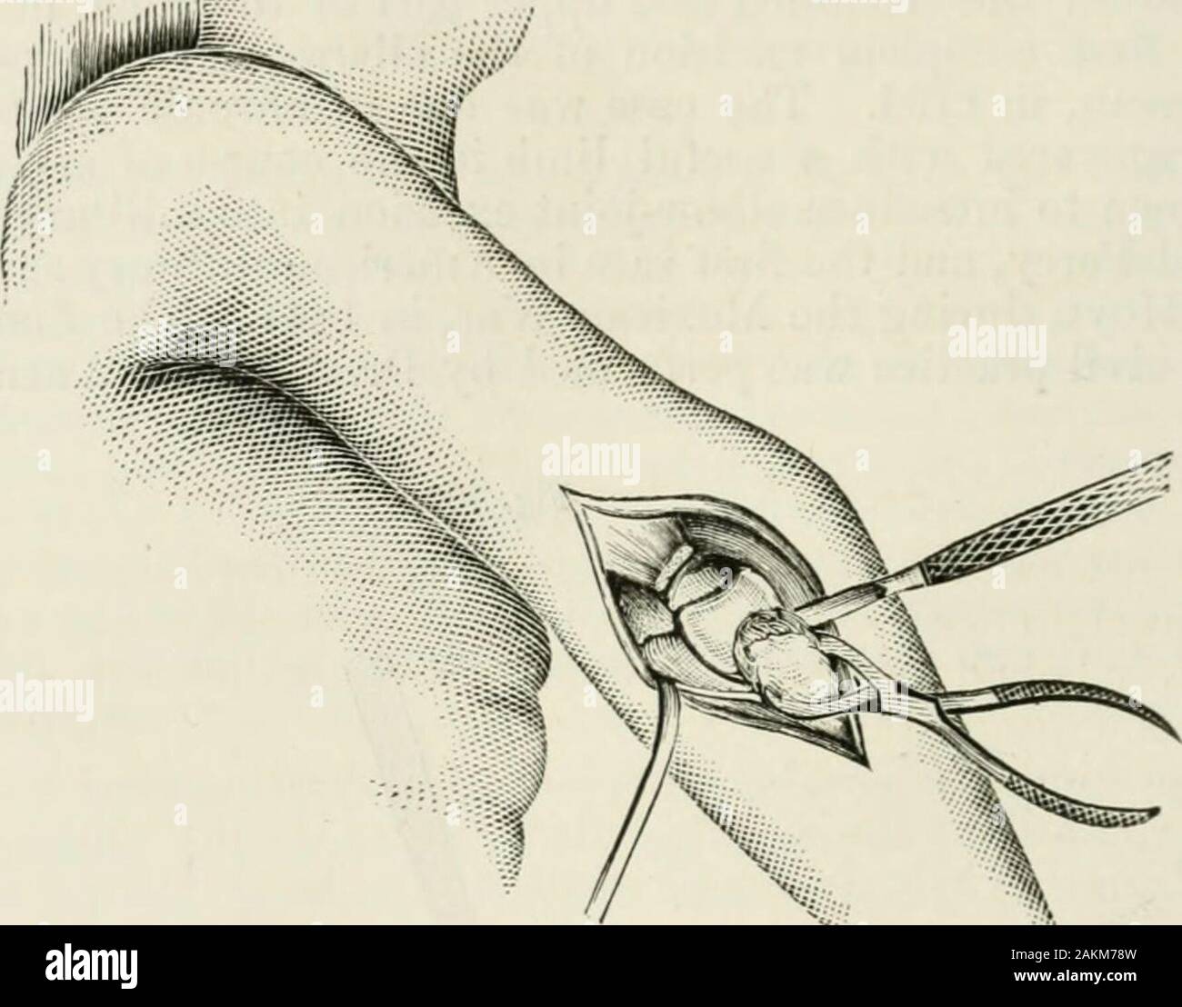 L'Encyclopédie internationale de chirurgie, un traité systématique sur la théorie et la pratique de la chirurgie . )Tion est d'éviter de blesser le nerf cubital, whichshould être soigneusement disséquée à partir de sa position derrière le condyle interne,le bord du couteau étant conservés près de l'os, et devrait ensuite être heldout oftlie avec un objet contondant ou crochet rétracteur. (Fig. 701.) dans les excisions pour Fig. 701.. L'excision de l'articulation du coude par incision longitudinale unique. Les maladies chroniques, il n'y a aucune difficulté à éviter le nerf, qui est sur-arrondi par épaississement et infiltré les tissus, et, en fait, pas besoin d'être s Banque D'Images