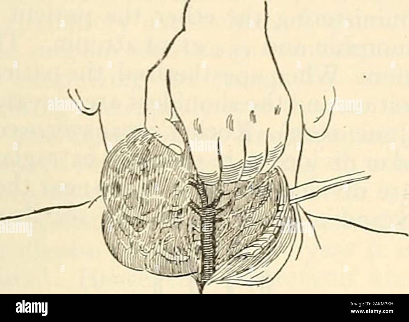 La chirurgie moderne, général et du dispositif . ould provoquer des saignements abondants),et il garde une distance sécuritaire de le nerf laryngé récurrent. Si le patient souffre de graves troubles respiratoires avec maladie myocardique, une anesthésie générale est contre-indiquée. Si l'éther est utilisé, après l'inconscient-ness est obtenu l'éther est donné par instillation insufflation. L'opération pour le patient est placé 1241 Goitre, couchés avec les épaules un peu soulevé et le cou déposé sur asand-oreiller afin de jeter la tête en arrière aussi loin que est compatible avec confort-capable la respiration. Un obHciue incisio Banque D'Images