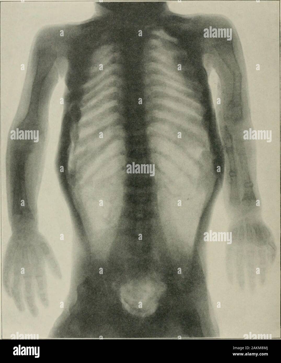 La pratique américaine de chirurgie : un système complet de l'art et la science de la chirurgie . Fig. 260.-Adolescent rachitisme. Coxa vara. Bien nourris, garçon de quinze ans. W^irregularepiphyseal ide, HNE. L'axe du col du fémur est beaucoup plus de l'horizontal et l'axe de l'arbre est tlian Jriginal.((normal.) Dans chondrodystrophia il existe une étroite mais plutôt linebetween assez régulier l'épiphyse et la diaphyse. Les arbres sont courtes, Unbowed, andusually, épais et l'éclipsant clinique est donc expliqué (Fig. 259). DOLESCENT rachitisme. CoXA ll.. Si la condition ci-dessus est vraiment une fin Banque D'Images