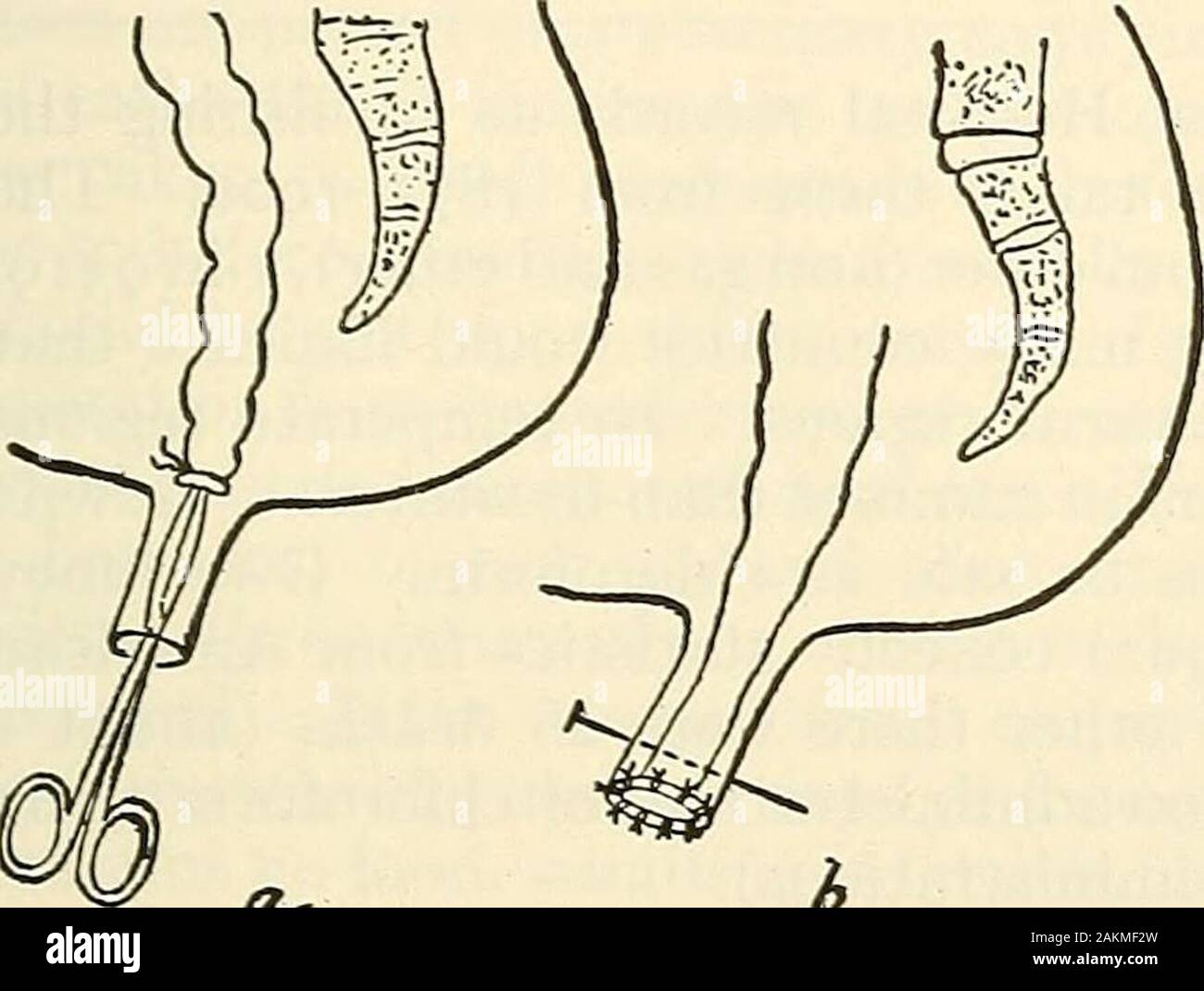La chirurgie moderne, général et du dispositif . l'intestin sauf le sigmoïde, attraper deux colliers dans le sigmoïde, l'une d'être sur le niveau de la promontoire. Diviser l'intestin entre eux.Free le mésosigmoïde par coupes latérales et amener le moignon proximal sur thebelly, ligaturer, et appliquer un sac-string suture pour l'inverser. Un incisionis gridiron alors sur le côté gauche et le moignon proximal est tirée à travers et il issutured là. Incisions sont désormais prévues dans les côtés et à l'avant pour libérer le therectum mferior, artère mésentérique est liée au-dessus et à gauche de la promon-tory Banque D'Images