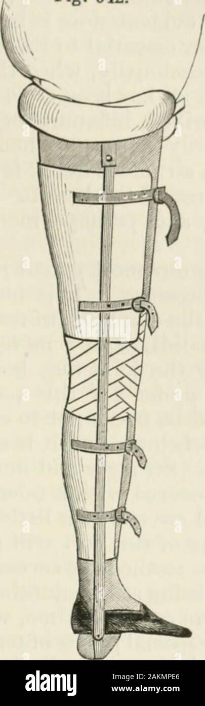 L'Encyclopédie internationale de chirurgie, un traité systématique sur la théorie et la pratique de la chirurgie . Thomass splint pour maladie du genou. Dnmbrowskis splint pour maladie du genou. sur le pied, des attelles sont moulés en feutre, en verre trempé dans l'eau ; ces entirelyencircle leurs portions respectives de la branche, ne laissant un léger jeu en face. Des mesures précises sont prises de la longueur de l'ditferentlimb-segments, et de bandes de métal suffisamment forts sont coupés en conséquence, l'un pour l'extérieur et une pour le côté intérieur, d'atteindre à partir de la cuisse-ring pour themalleolus ; lorsque t Banque D'Images