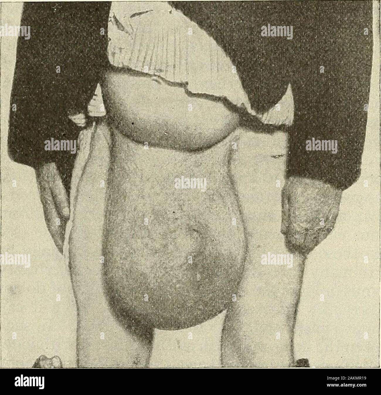 La chirurgie moderne, général et du dispositif . tient le haut. Si un traitement radical n'a pas été essayé, appliquer un pansement et apad spica de l'aine, et plus tard une poutrelle. Une botte doivent pasêtre portés si un traitement radical n'a été faite. La mortalité.-Les cas de hernie étranglée par les taxis irréductible du per-luo automatiquement tous mourir sans opération. L'opération suivante est mortahty grand;il n'est pas en raison de l'exploitation, mais est dû à l'état, et est dû notamment au retard de fonctionnement ou toforcible taxis antécédente.Sultan, sur un total de1429 herniotomies, l'esti-mates la mortalité à20.7  %. Estimatingthe mortal Banque D'Images