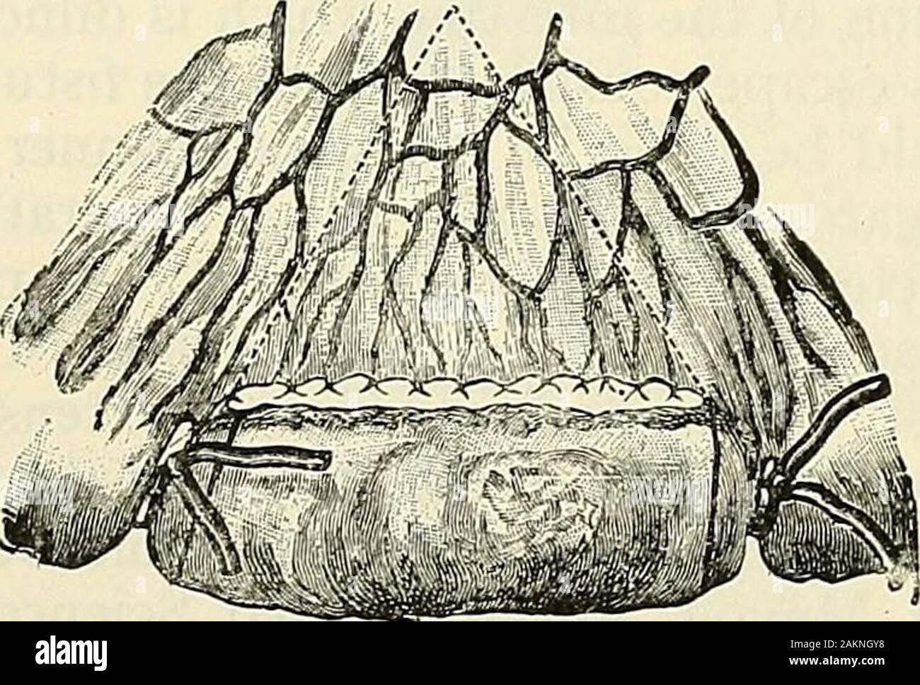La chirurgie moderne, général et du dispositif . ourished. Ruggi supprimé ii pieds, Witallremoved lo pieds 8 pouces, Von Eiselsberg, ii pieds 8 pouces, et Obulinski, 12 pieds 2 pouces. 848 retirés 11 pieds 2 pouces pour thrombosisand mésentérique le patient s'est rétabli. Childe successfiilly retiré 9 pieds 6 pouces de ofsmall pour l'intestin de l'embolie pulmonaire artère mésentérique. Hayes retiré 8 pieds4I pouces à partir d'un garçon âgé de dix ans, et le patient était bien monthslater 8. Dressman rapporté 26 cas dans lesquels plus de 3 pieds 3 incheshad été retiré (Alexander Blaney, Brit. Med. Jour., 16 novembre 190 Banque D'Images