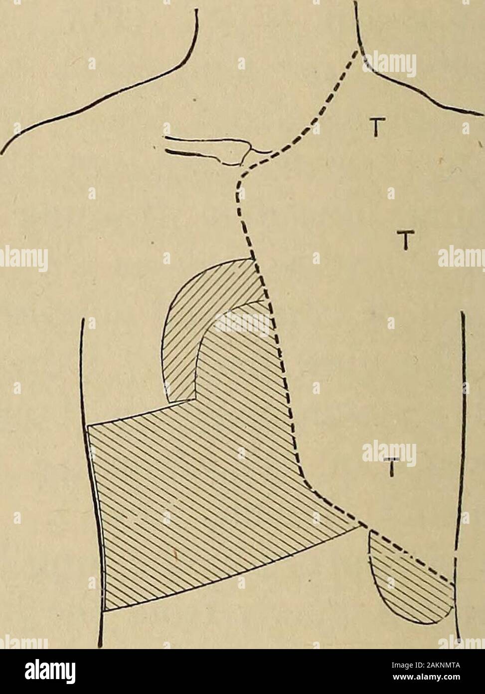 Un traité sur les principes et la pratique de la médecine . Je II Fig. 36.-I. Pleurésie effusives de latéralité gauche, montrant dulness relatif du cœur (A),(B), l'épanchement de la planéité du foie (C), et le liquide empiéter sur Traubes espace demi-lune, mais une petite partie de ce qui demeure résonante (D). Dans les plus grandes marques d'atteindre, e. g., jusqu'à la notation en blackline, le coeur dulness relative peut être poussé au-delà de la ligne en pointillés (plus de C). II. Pneumothorax gauche marquée par tympany (T, T), le poussant sur le médiastin et alsothe coeur à droite, et poussant vers le bas le lobe gauche du foie et la rate. attitude est le CCRVSI Banque D'Images
