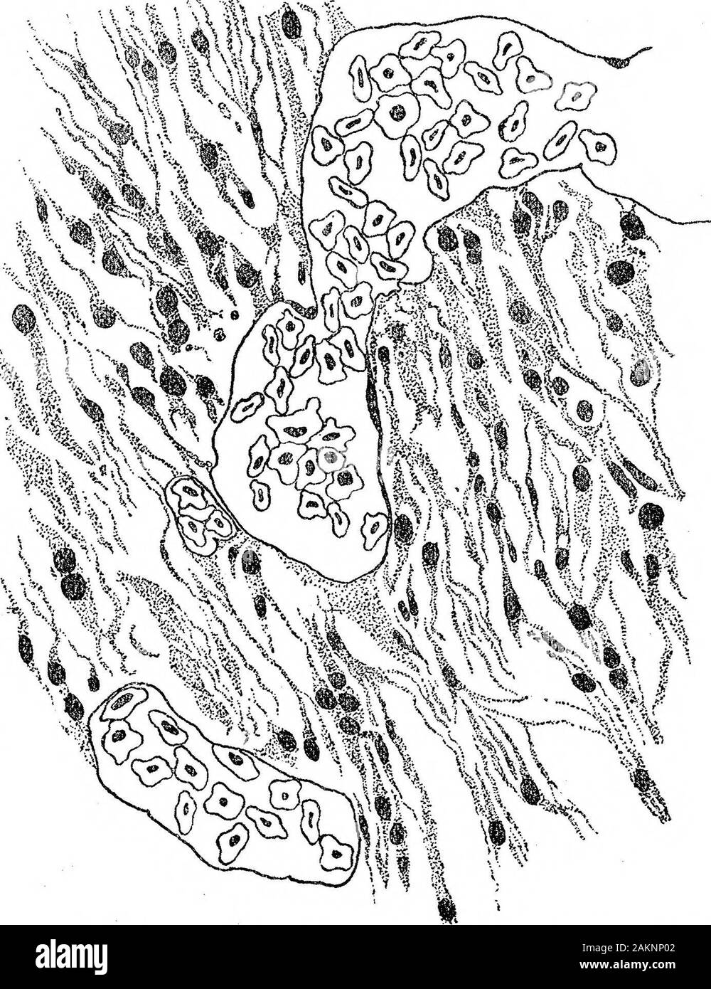 L'importance de la distribution Zoologique, la nature de l'activité mitotique et la transmissibilité du cancer . Cinquième. 7.-malignes adénome de Grondin. Tumeur primaire. Cavité péritonéale. X 2250 (réduit). 76 Sur le parc zoologique de diffusion, etc., de cancer, [janv. 12,. Fi0. 8.-sarcome à fusée. Codiisli. Des nodules secondaires, mur de vessie natatoire. X 1500 (réduit). DESCEIPTION DE PLAQUE. Abeno-Carcinoma op de fontaine. (1) Les chromosomes dans le stroma mitoses sont longues boucles en forme de V, qui se répartissent de façon longitudinale, 24.. en nombre. Ils sont en comparefig ; tjpe somatiques. 2 à partir de la tumeur. (2) Somat Banque D'Images