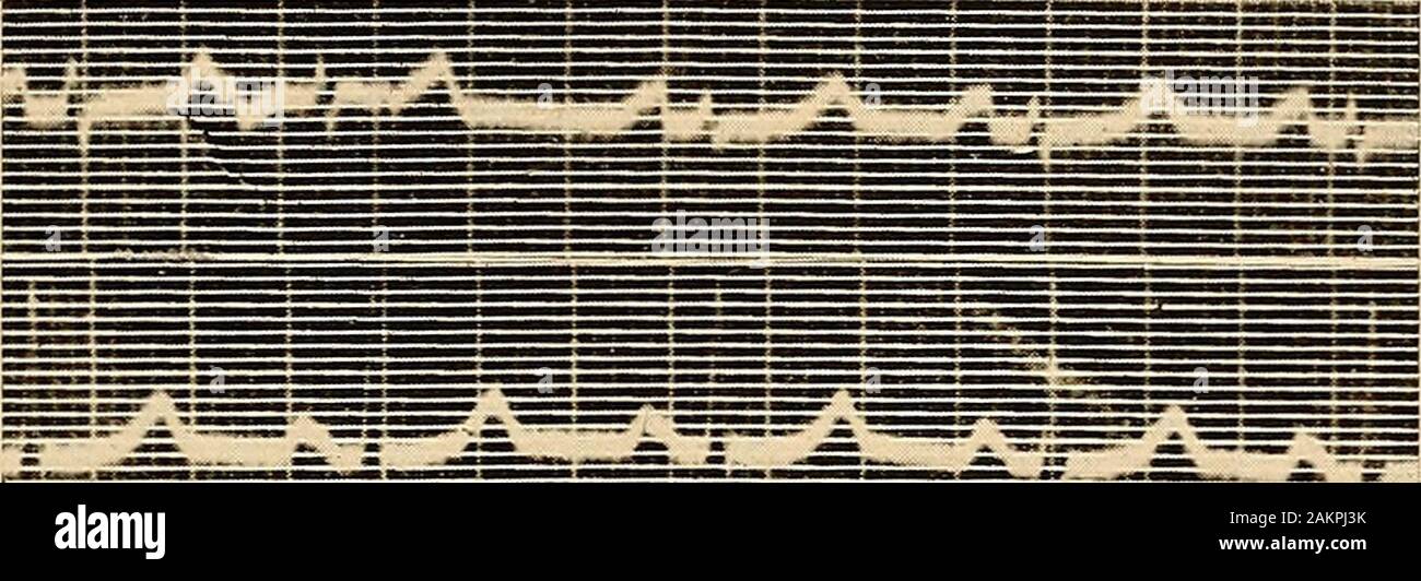 L'électrocardiographie clinique . snode, ou entre le noeud et l'oreillette, et pense que le firstportion de la vague a été la manifestation de l'activité sinusale. L'onde P Thenotched est fréquemment observée dans la sténose mitrale (Fig. 115). L'onde P NEGATWE (inversée) de la négativité de l'onde P dans toutes les dérivations de l'électro-cardiogramme est invariablement preuve d'un rythme ectopique. Ritchie,Einthoven, Fahr et deWaart, Von Hoesslin, Wilson et attribué DES ANOMALIES DE L'onde P 137 la négativité de l'onde P à un changement dans le rythme cardiaque-bouilloire,comme dans la tachycardie auriculaire flutter, et ainsi de suite. Carter et Banque D'Images