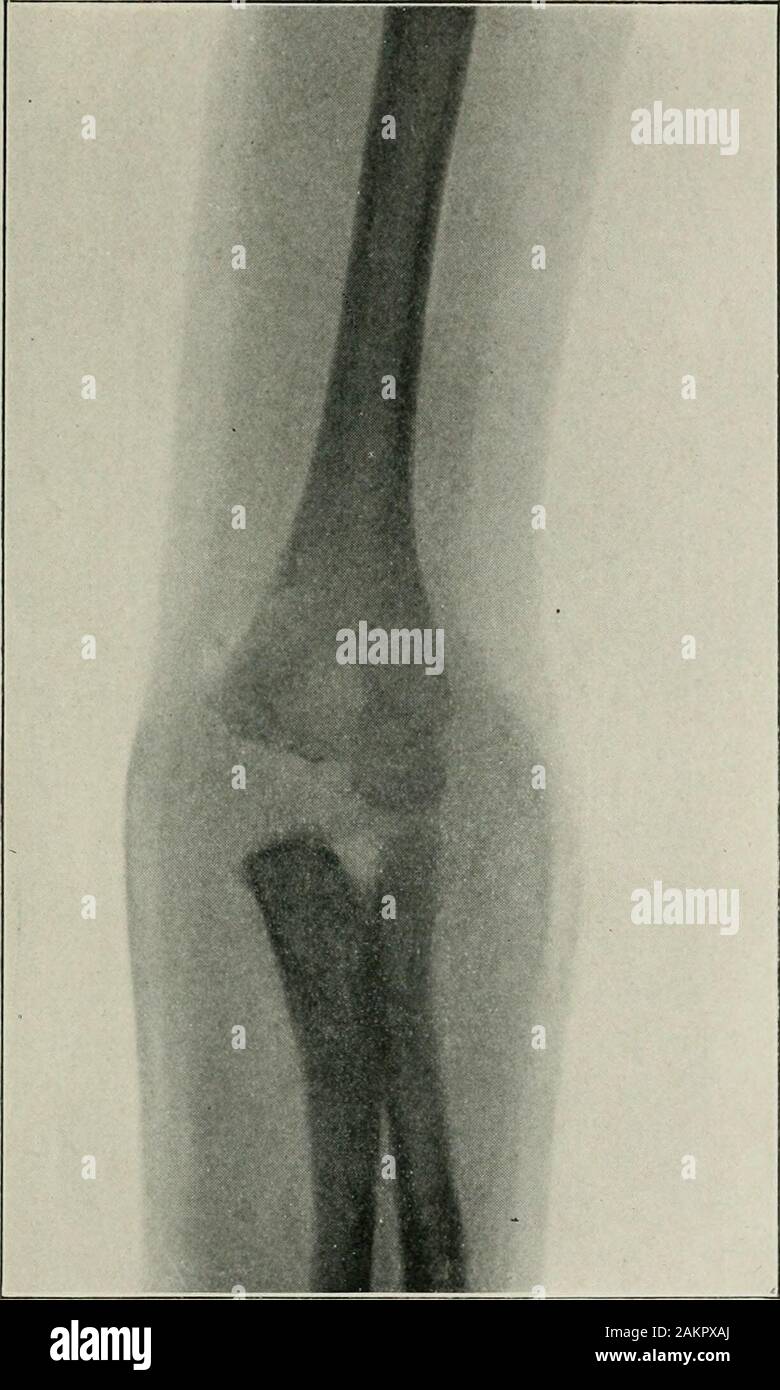 La pratique américaine de chirurgie : un système complet de l'art et la science de la chirurgie. l'articulation. (Original.) par la présence de l'effused sang ont bien sûr aucune relation causale à thediathesis, et sont purement secondaires. En ce qui concerne l'étiologie, également, rien n'est connu au-delà du fait qu'il ishereditary à un degré considérable et que la transmission de l'il-reditary est dégradé par les descendants mâles. Dans l'examen de ce sujet, il peut être bien à relier les points essentiels dans l'évolution clinique de deux cas récemment sous observation : non tuberculeuse des inflammations des articulations. Banque D'Images