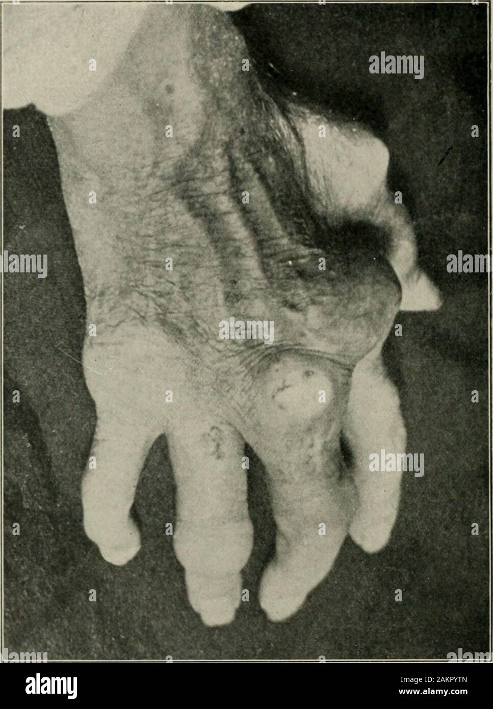 La pratique américaine de chirurgie : un système complet de l'art et la science de la chirurgie de l'altitude correspondant . la température. C'est très caractéristique de tous les processus qui jointsare toxiques concernés où l'absorption est en cours. L'excès d'acide urique dans theurine serait également très suggestif de la goutte. Dans les examens par rayons x de ces cas, les lésions infectieuses sont whollyin les parties molles à propos de l'articulation. Il n'y a pas de dépôts d'urate de sodium-etn˚érosions de l'os ou de cartilage sauf dans les infections sévères très wheresuppurative des changements ont eu lieu. Dans ce cas, l'un à l'occasion, s Banque D'Images