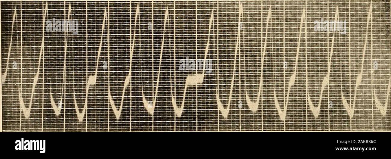 L'électrocardiographie clinique . Fig. 67.-contractions ventriculaires précédant un paroxysme de ven-tricular tachycardie. Pour le calcul de l'électrocardiogramme II.. Fig. 68.-paroxysme de la tachycardie ventriculaire. 180 taux. Dans Electrccardograi Dérivation I. rythmes ectopiques tachycardies et oreillettes ventricules 91 et contrat au même taux, pour eachcomplex est identique à la complexe adjacent, et si andventricles oreillettes ont été partie à des taux d'indépendants, l'auricularcomplex parfois être superposées et détruire le contourof la courbe générale. Il est rare que le taux du ventricule Banque D'Images