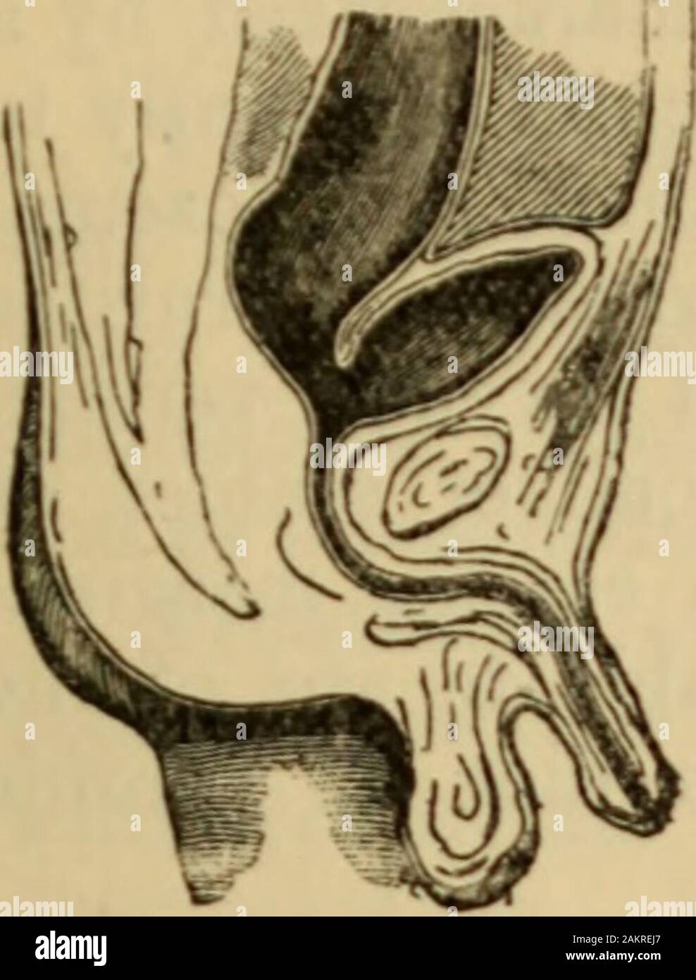 Un texte américain-livre sur les maladies des enfants .. . MALFORMATIONS DU  RECTUM ET ANUS. 599 Fig. 7.. Anus absente ; l'Recturn se termine dans la  vessie. (Après la balle.) Fig. 8.