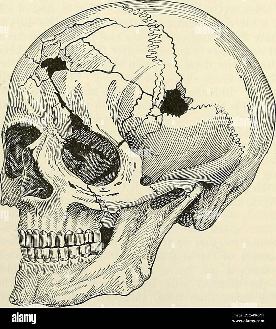 La chirurgie moderne, général et du dispositif . accompagné d'fractureof le crâne. Thesewounds sont très danger-ous ; corps étrangers (os, cheveux, vêtements, etc.) areoften introduite dans le cerveau, l'hémorragie est en général graves et sans traitement approprié le sepsis est almostinevitable. Ces cas sont très fatale, même si certains recouvrements areon étonnant record. Fig. 519 et 520 fractures-show de feu du crâne. Les symptômes d'une blessure au cerveau peut être légère et différé ou immédiat et peut-être écrasante ; elles dépendent de l'emplacement et l'étendue de l'theinjury. La localisation des symptômes peuvent exister, et l'encéphalite wi Banque D'Images