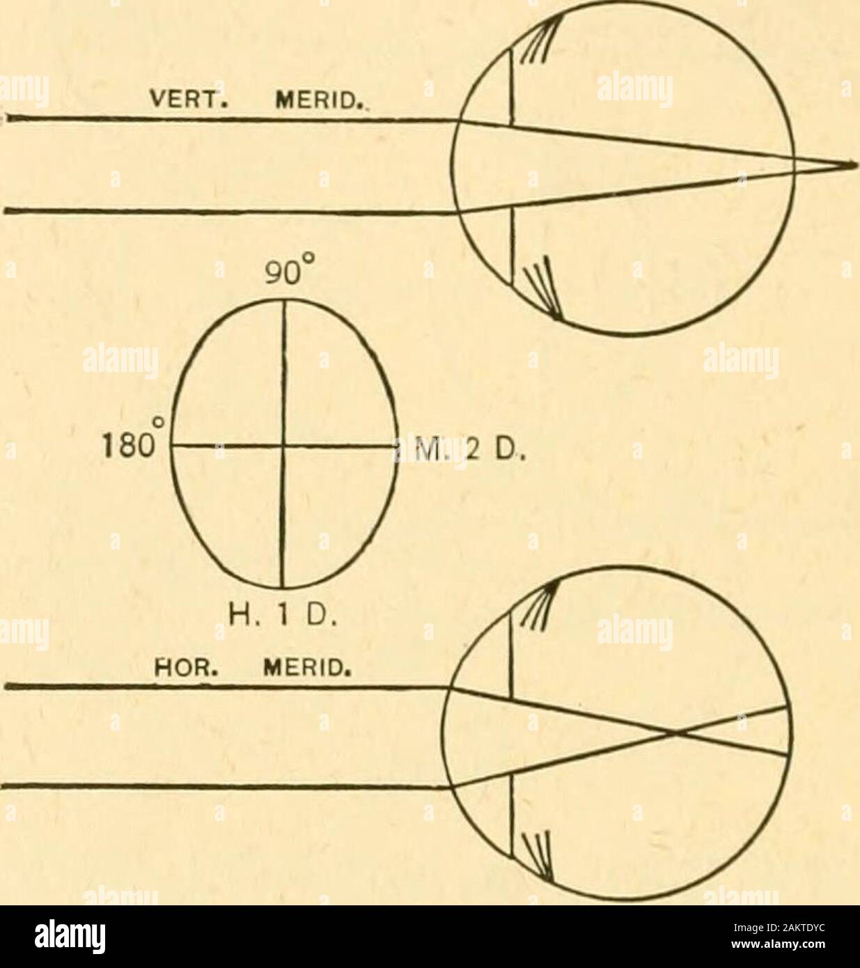 La réfraction de l'œil ; y compris un traité complet sur opthalmometry ; un texte clinique-livre pour les étudiants et les praticiens . Via. 17. 26 LA RÉFRACTION DE L'ŒIL de l'horizontale, est moins courbé, et par conséquent, il est d'astig-matism contre la règle. 5. L'astigmatisme mixte contre la règle. - L'axe vertical moi-ridian est hypermetropic, rayons porte arrière de la rétine, andis Moins ondulé que le méridien horizontal, qui est myope, et se concentre dans les rayons avant de la rétine.. Fig. 18. Par le diagramme ci-dessus nous voyons que l'astigmatisme peut beagainst la règle dans toutes ses formes. Tant que l'axe vertical moi-r Banque D'Images