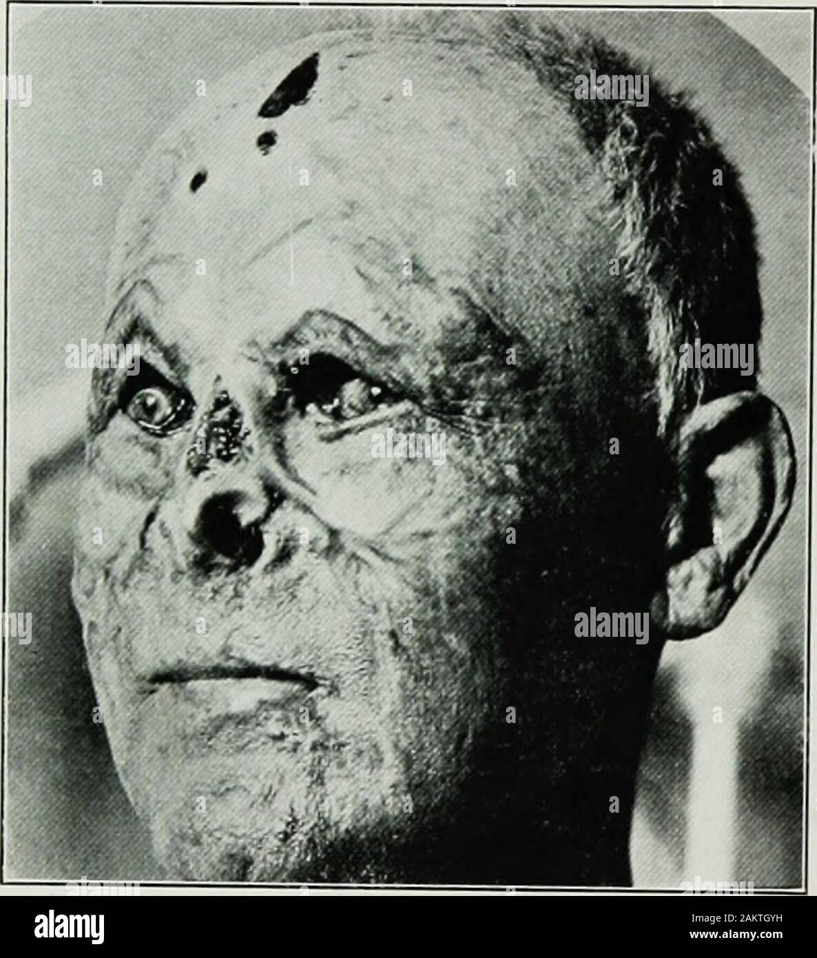 La chirurgie de guerre du faceA traité sur la restauration en plastique après blessure au visage par Jean BRoberts ..préparé à la suggestion du paragraphe sur le plastique et la chirurgie buccale connecté avec le bureau du chirurgien en generalIllustrated ecomeinfected avec 256 chiffres .. Après la séparation des marécages les ulcères sont à traitée comme décrit précédemment. Oftenexceedingly métallique astringents sont utile pour tenir les granulations redondants andhasten la réparation de la violation de la continuité. La greffe de peau, dans itsnumerous formes, est souvent nécessaire, et diminue la contraction de thecicatrix. Elle devrait être faite au début Banque D'Images