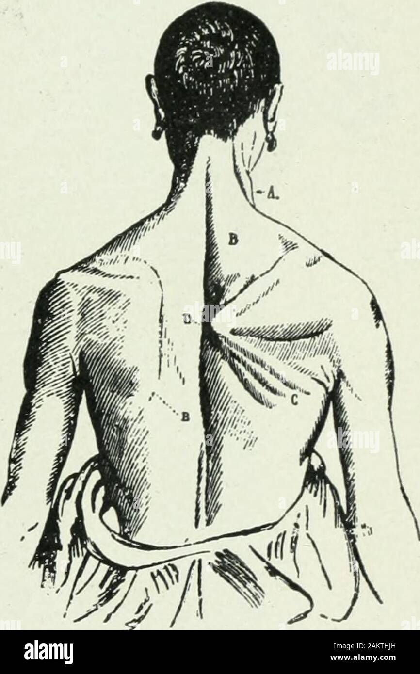 L'anatomie et la kinésiologie appliquée ; le mécanisme de mouvement musculaire . les bras, comme le broyage avec anax, frappant avec un marteau, tirez-ing bas sur une corde, et rowmg. SERRATUS MAGNUS. Ce muscle, du nom d'itsserrated anterioredge ou à dents de scie, se trouve sur la surface extérieure de la côtes sur le côté, couverts par l'omoplate à l'arrière et thepectoralis majeure en avant. Il liesimmediately sous la peau pour un espace un peu plus grand que la main juste en dessous de l'aisselle ou arm-fosse, ses cinq sections inférieures montrant clairement par la peau lorsque le bras est soulevé contre résistance, comme en Fig, 39. L'origine.-e Banque D'Images