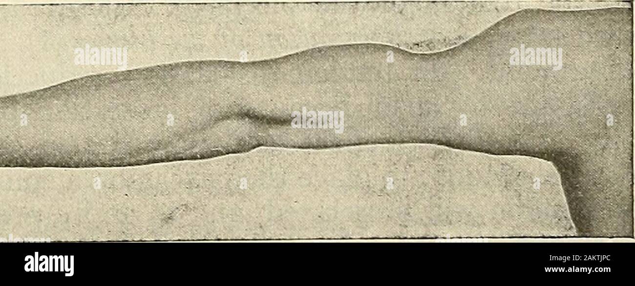 La chirurgie moderne, général et du dispositif . Fig. 450.-auteurs cas de rupture de la tête du biceps. Le traitement. En rupture limitée traiter comme une tension sévère. Dans treatingextensive la rupture d'un muscle, quand les extrémités sont largement sepa-rated, exposer par incision, unir les extrémités par des sutures divisé chromicizedcatgut (Fig. 109) et coudre le haut de la peau avec l'intestin.   Traiter la partie cas par patronnés se détendre et lutter contre l'inflammation en appropriatemeans. Mouvement passif et des massages sont employés dès que Union européenne est ferme.en rupture de l'extenseur quadriceps femoris, opération shou Banque D'Images