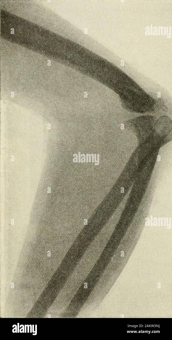 La chirurgie moderne, général et du dispositif . que prona-tion ainsi que l'extension est re-quis pour produire le dommage;de nombreux chirurgiens affirment que l'ex-tension et l'adduction sont thecausative forces. Hutchinson affirme que la supination peut causer une subluxation.Bardenheuer affecté comme causes des chutes. Les symptômes sont très caractéristiques. L'histoire pointe vers la blessure.La douleur et peut-être un clic peut se faire sentir sur le coude, et la douleur et Acliquez sur peut aussi être ressenti dans le poignet au moment de l'accident. Le armhangs par le côté, avec le coude fléchi légèrement à joint et l'avant-bras à mi-chemin entre pronation et supin Banque D'Images