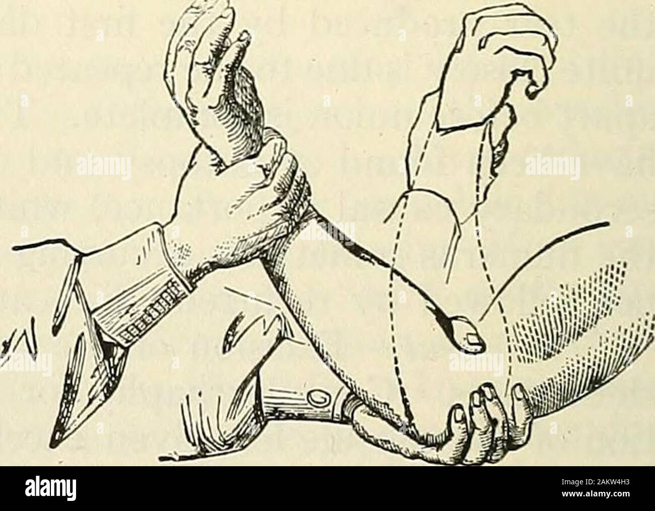 La chirurgie moderne, général et du dispositif . voir raccourcir-ing ; il n'y a pas d'altération de l'normalrelation processand entre le condyle de l'olécrâne et la projection en face de l'articulation n'est au-dessus du pli du coude du coude. Traitement de la dislocation en arrière.-dans la dislocation des deux os de l'avant-bras, parce qu'il verra bientôt im-possible, et d'une luxation non réduite signifie un membre sans les pouvoirs, offlexion, pronation et supination. Le chirurgien peut placer son genou dans le coude frontof-joint, saisir les patients wrist, appuyez sur le rayon et ulnawith son genou, et plier les fo Banque D'Images