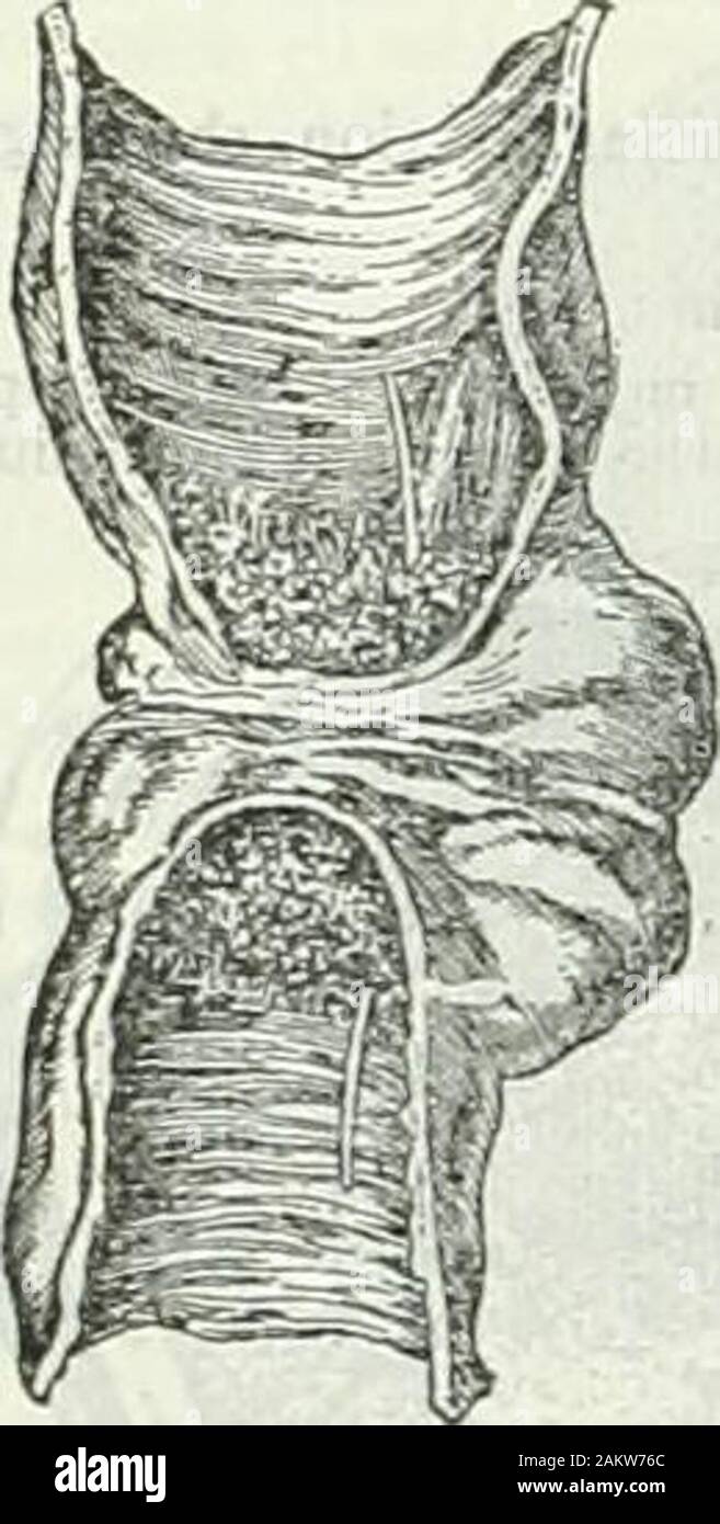 L'encyclopédie Britannica ; un dictionnaire des sciences, des arts, de la littérature et de l'information générale . Fig. 17.-Cancer du côlon sigmoïde de la flexure coIon" (pnim redessinés Zieglers pj/Afifogiru najomy/4, avec la permission de l'ol Macmillan & Co.) Fig. 16. de la marge de progression de l'estomac cancer;colonnaires. et dans les premiers stades, il peut y avoir aucun;id) le glandssoon lymphatiques voisins deviennent enflés et sensibles, show-ment qu'ils sont le siège d'metastaticdeposits : (e) dans la peau, le carcinome squamous de l'ulcération se produit rapidement. Ulcus rodens.-Cette montre elle-même comme aslowly ulcération progresse Banque D'Images