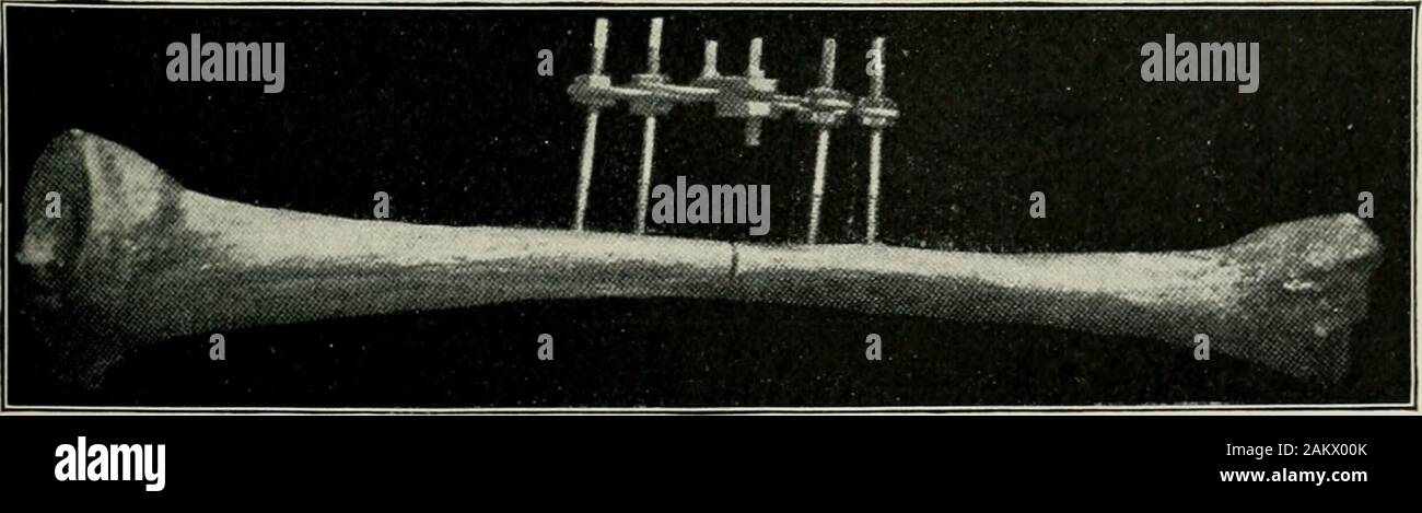 La pratique américaine de chirurgie : un système complet de l'art et la science de la chirurgie . Fig. 116.-pièces distinctes de la pince. (Parkhill.) correspondant à l'extérieur, et la paire plus courtes à l'intérieur. Eachwing plaque est fixée sur son axe par deux écrous fonctionnant sur le filetage supérieur,l'un au-dessus de la plaque et l'autre ci-dessous, pour l'exactitude de l'ajustement. Whenin une aile position recouvre la plaque de l'autre dans chaque moitié de l'instrument,. Fig. 117.-Vue de côté du collier après qu'il a été appliqué à la fracture du tibia. (Parkhill.) lorsqu'il est serré et la paire se trouvent côte à côte. Ils sont attachés ensemble par Banque D'Images