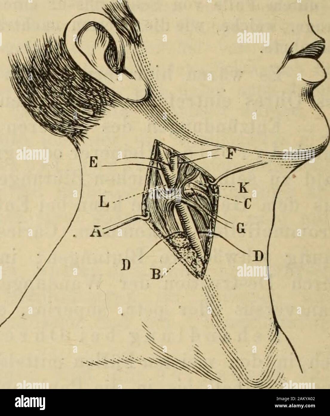 Lehrbuch der . Ohrenheilkunde ternach abwärts endet. Des Durchtrennung präparirtman muscle platysma nach den inneren Rand des Kopfnickers dieFascia frei und spaltet hiebei infrahyoidea. Lässt Nun man mit den Hacken Kopfnickernach Zungenbeinmuskeln aussen, die mit der unteren Schilddrüse Paukenhöhle Blutung 300 nach :, Carotis-Unterbindung ; fig. 64. innen aus ; wo ist ein kleines vorhanden Struma, ist es besser, dieSchilddrüse abzuziehen blos mit dem collés. Mit dem doigt über-zeugt man sich noch von der Lage des Gefässes, da es mit dem einenHacken undlegt weggezogen sein konnte die Arterie sorgfäl Banque D'Images