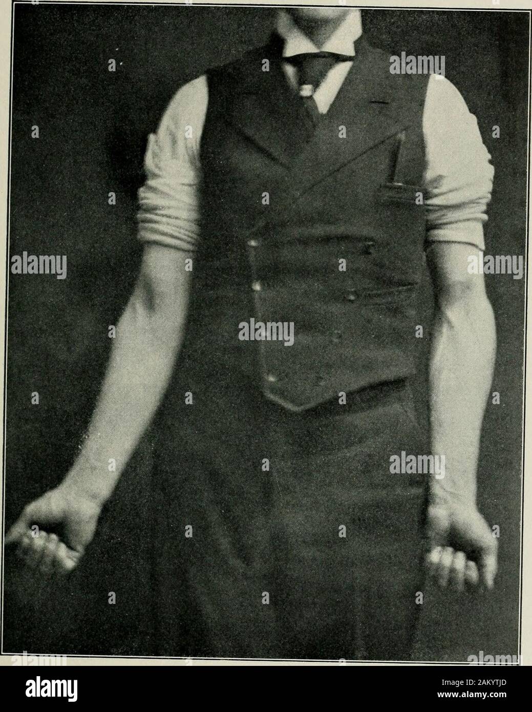 La pratique américaine de chirurgie : un système complet de l'art et la science de la chirurgie . des l'articulation du coude alors que c'est mais slightlymovable : activement par crépitation : et, enfin, par un gonflement de l'articulation en conséquence de l'épanchement intra-articulaire de sang. La fracture est parfois partlyintracapsular et en partie. extracapsulaire Si elle résulte d'une force directe uniquement, et le capitellum de l'humérus est rompu par le chef du rayon, crepi-tus peut être déterminé en pronation et supination de l'avant-bras avec thefingers mis sur le condyle externe. Il y a souvent une projection distinctes je Banque D'Images