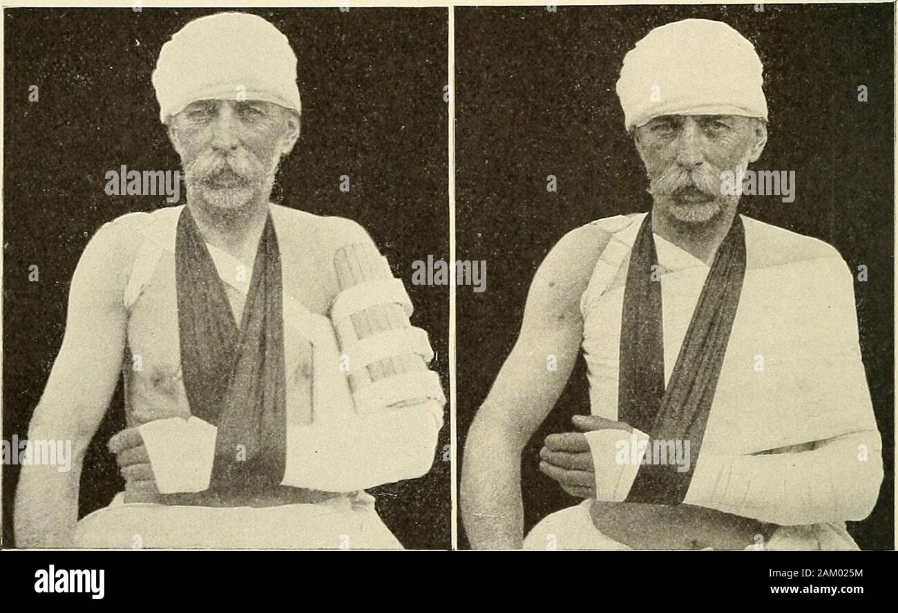 La chirurgie moderne, général et du dispositif . il condyle interne de l'humérus.Une plaque occlusale est droit et court appUed recto et un autre en arrière, chacune étant lalongueur du bras. Une épaule-cap est appHed, quelle pac est prolongée être faible dans une attelle angulaire externe atteignant jusqu'à la basse-thirdof l'avant-bras (Fig. 304) (Manuel de traitement chirurgical, par andBurghard Cheyne). Le coude est portée à un angle droit avec le bras et l'avant-bras est placé à mi-chemin entre la pronation et la supination. Comme andBurghard Cheyne dire : il est nécessaire que le bras doit pendre verticalement à côté de l'axi Banque D'Images